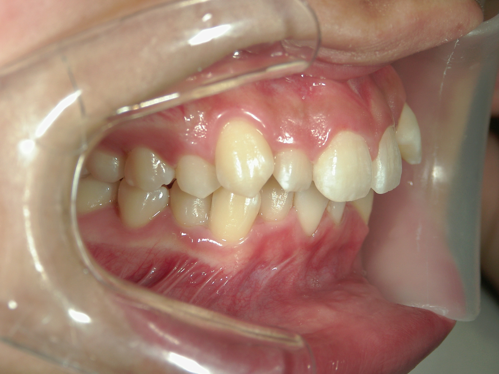 インビザライン矯正　症例（17）