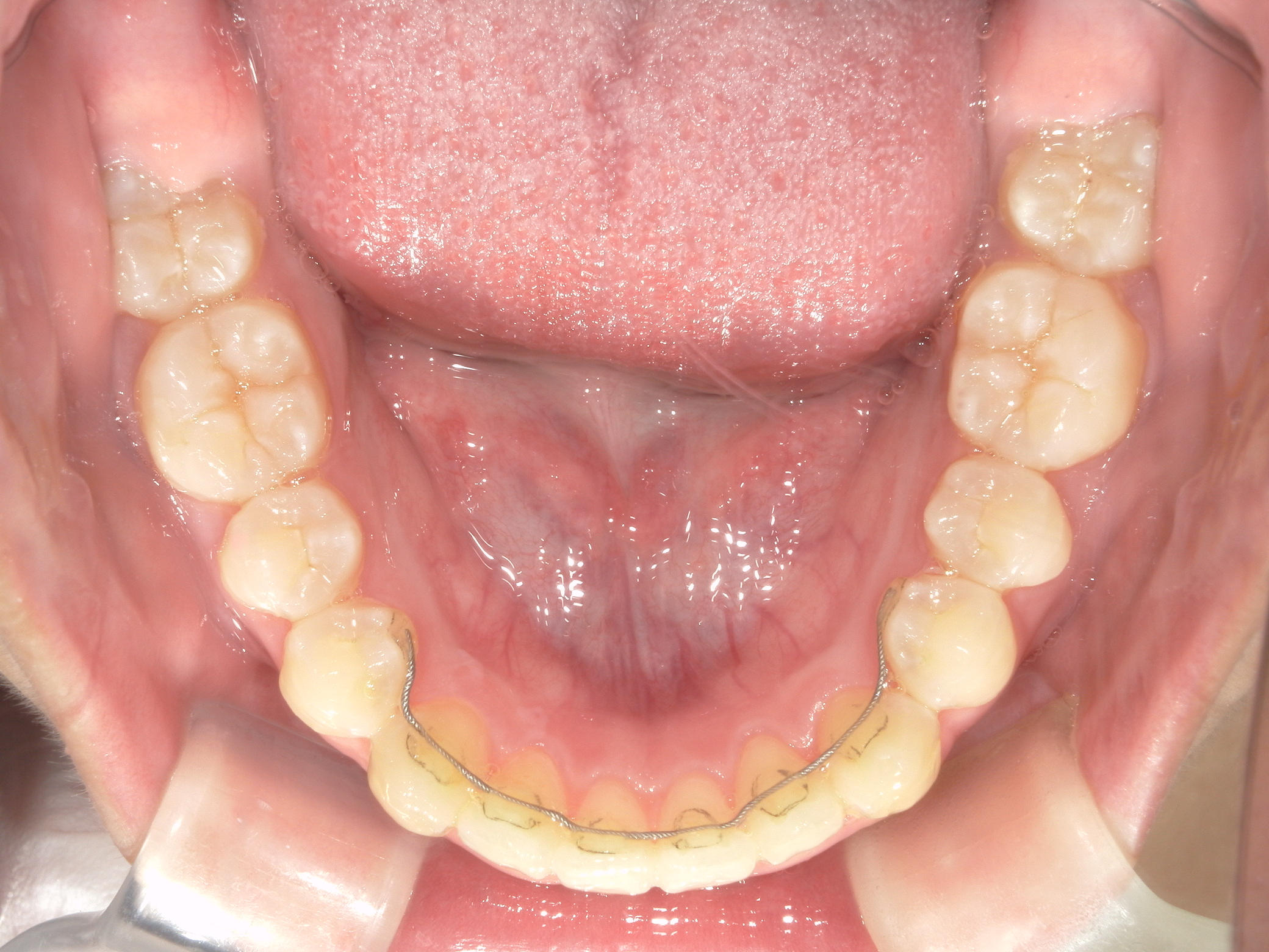 インビザライン矯正　症例（17）