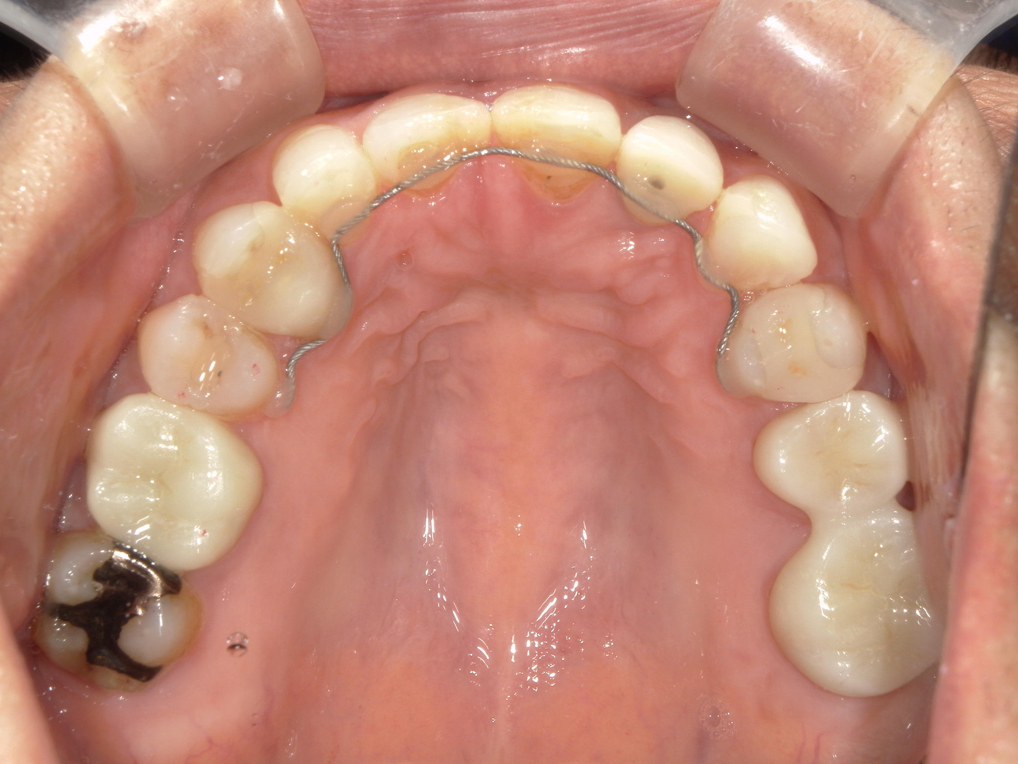 全顎ワイヤー矯正　症例（60）