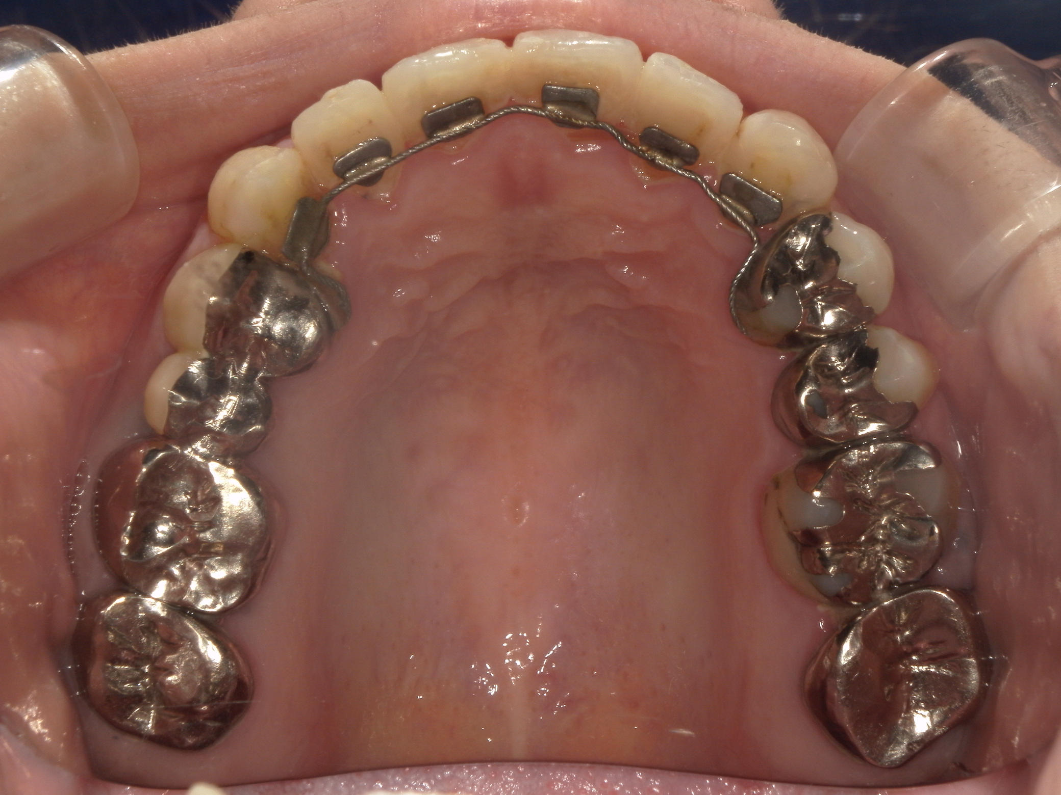 プチワイヤー矯正　症例（43）