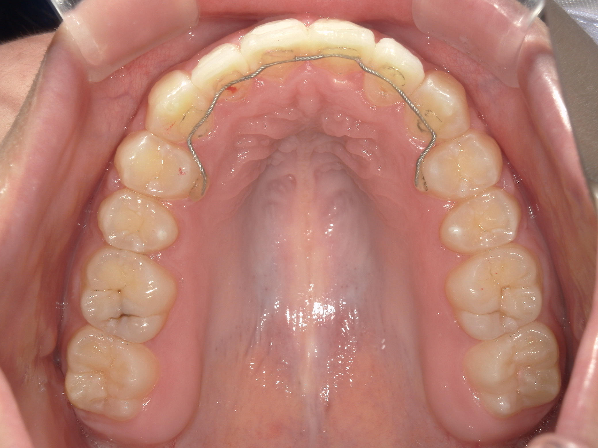 プチワイヤー矯正　症例（45）