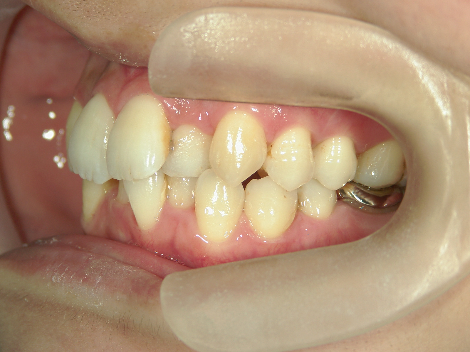 全顎ワイヤー矯正　症例（62）