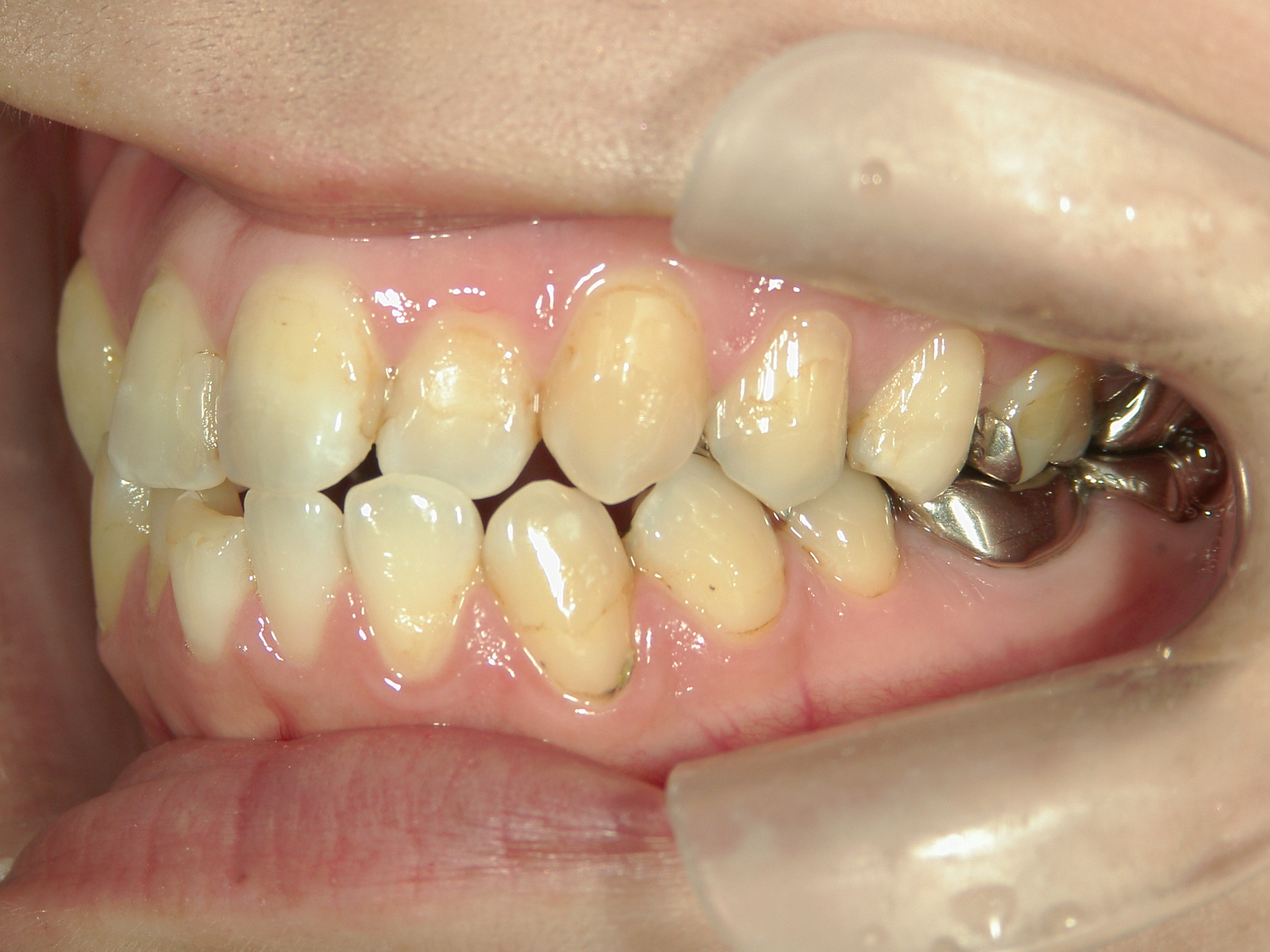 プチワイヤー矯正　症例（43）