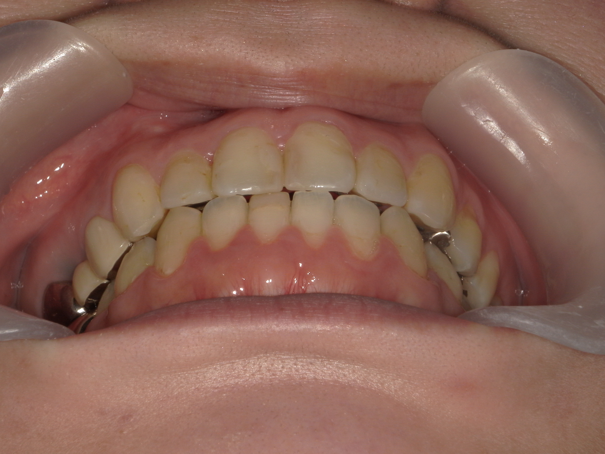 プチワイヤー矯正　症例（43）