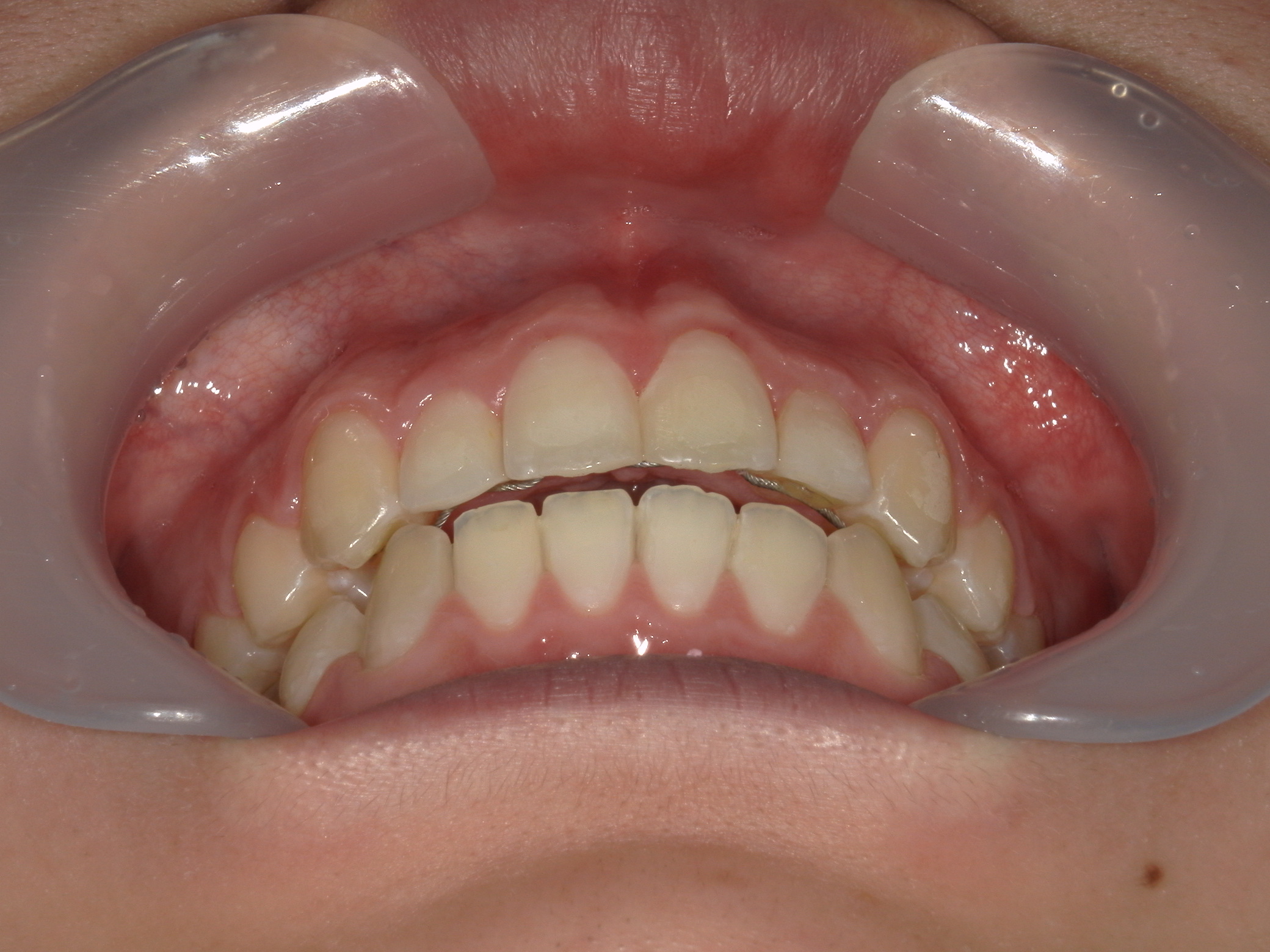 プチワイヤー矯正　症例（45）