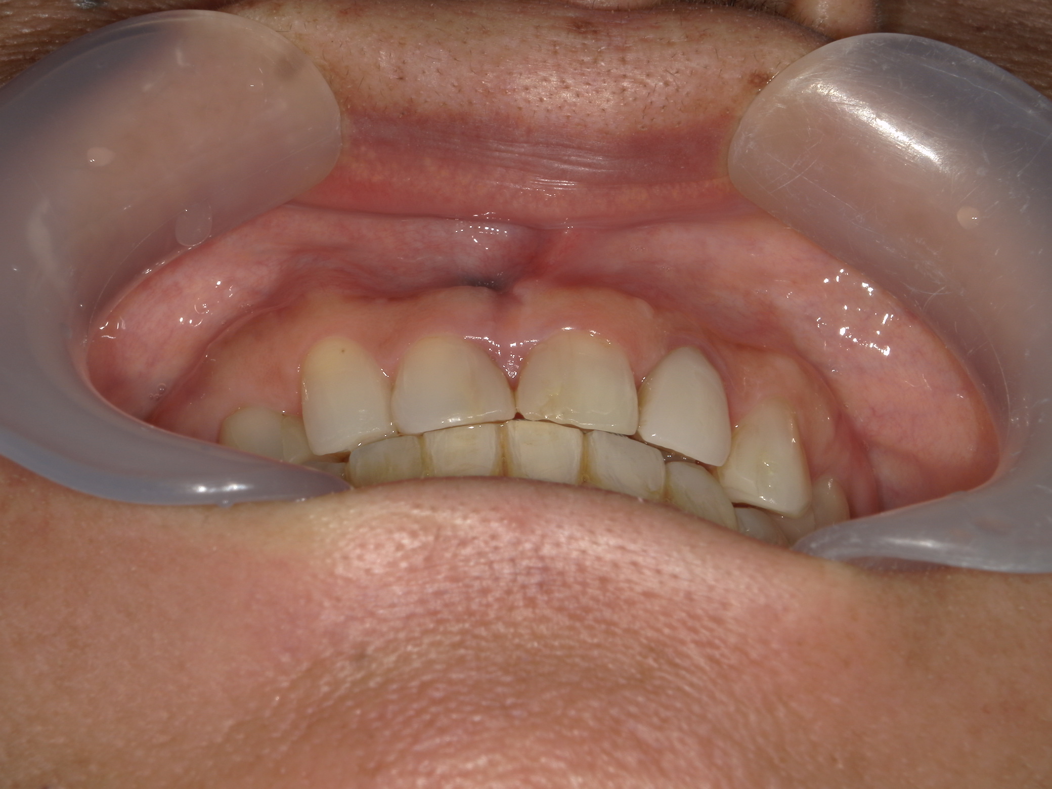 全顎ワイヤー矯正　症例（60）