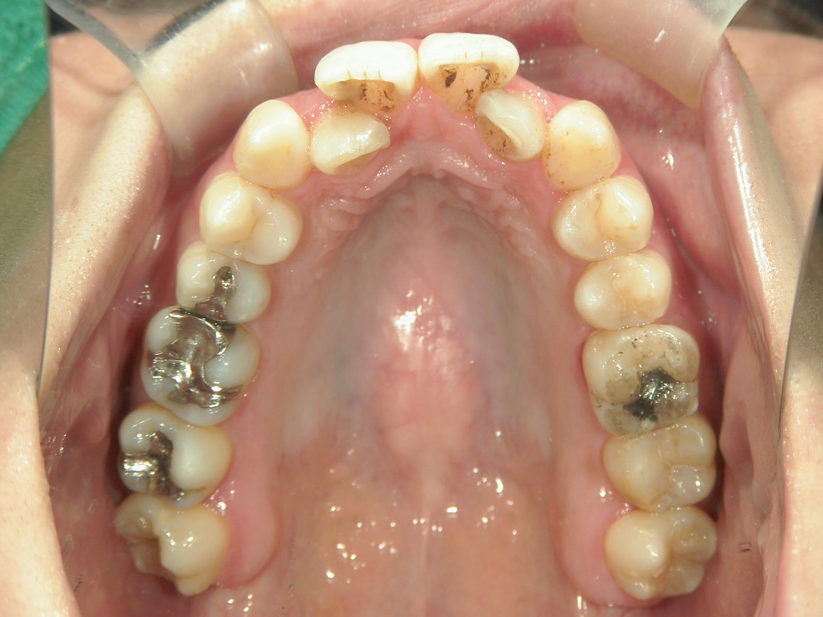 全顎ワイヤー矯正　症例（62）