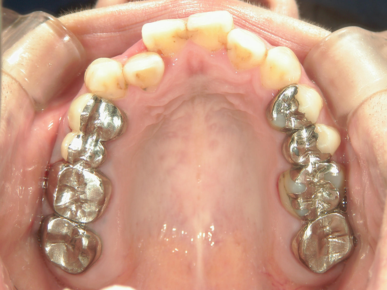 プチワイヤー矯正　症例（43）