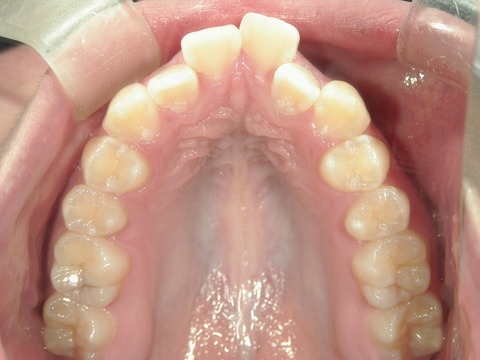 プチワイヤー矯正　症例（45）