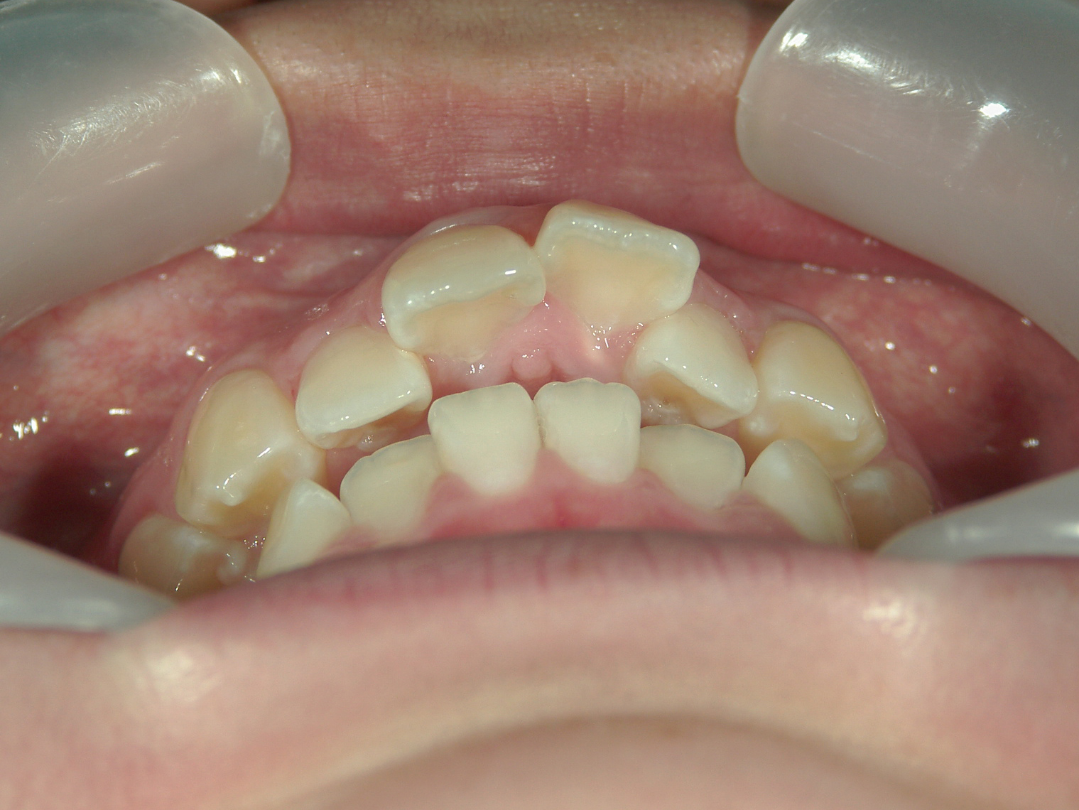 プチワイヤー矯正　症例（45）