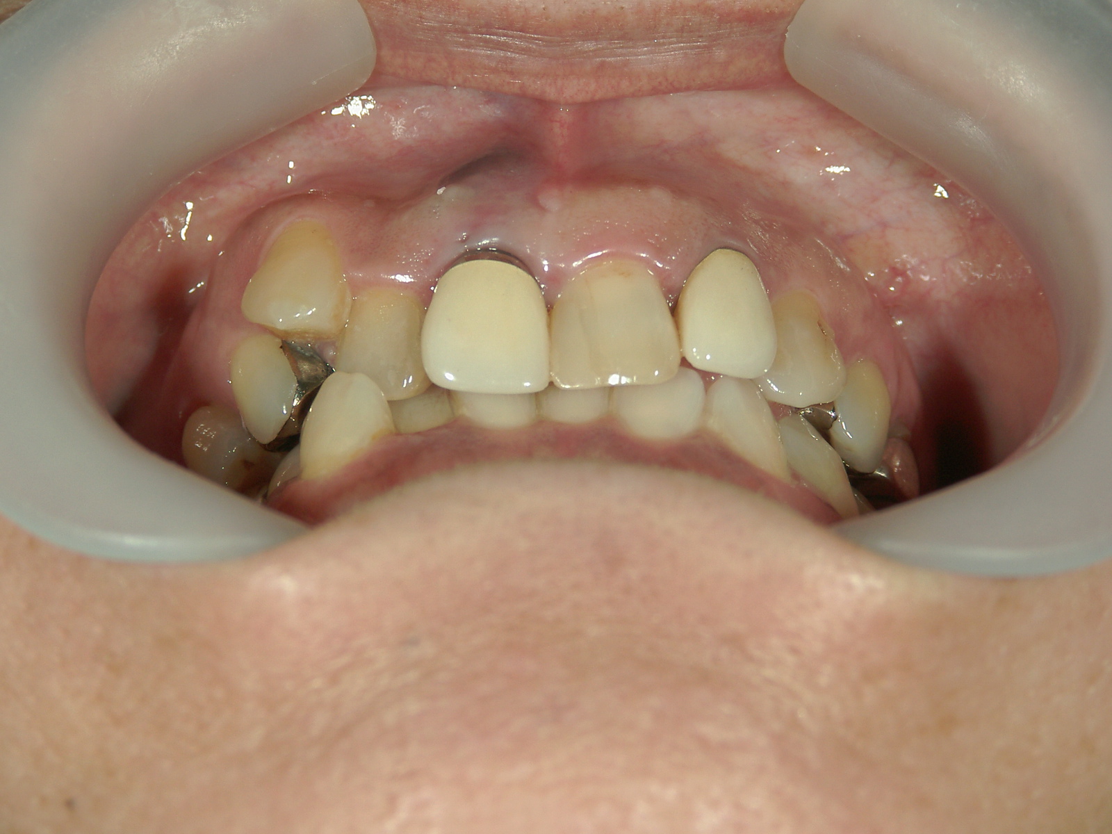 全顎ワイヤー矯正　症例（60）