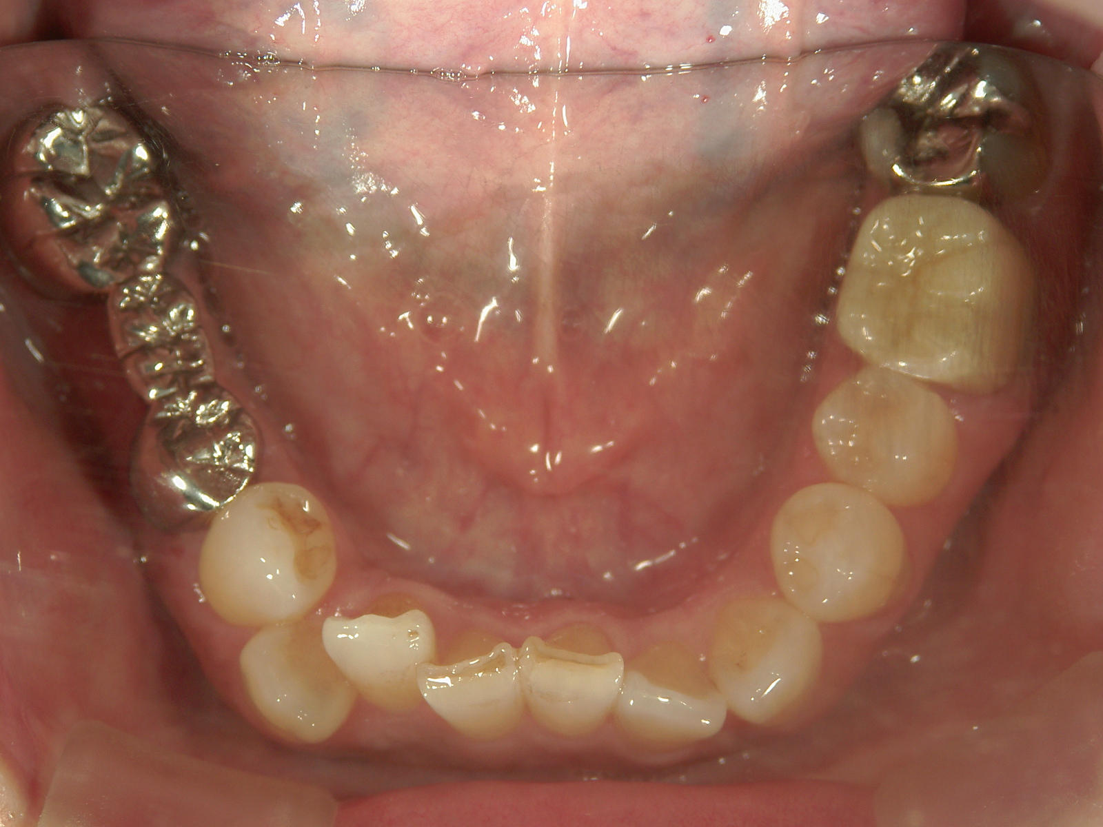 全顎ワイヤー矯正　症例（60）