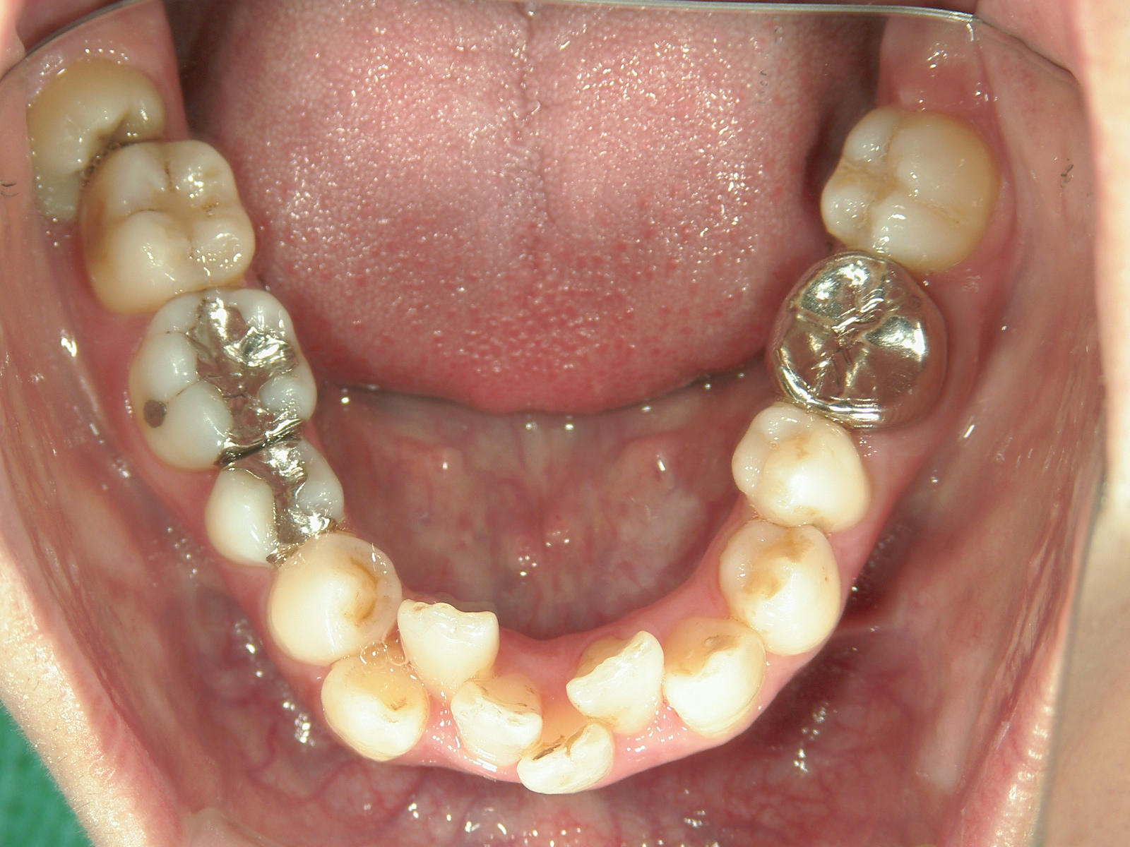 全顎ワイヤー矯正　症例（62）