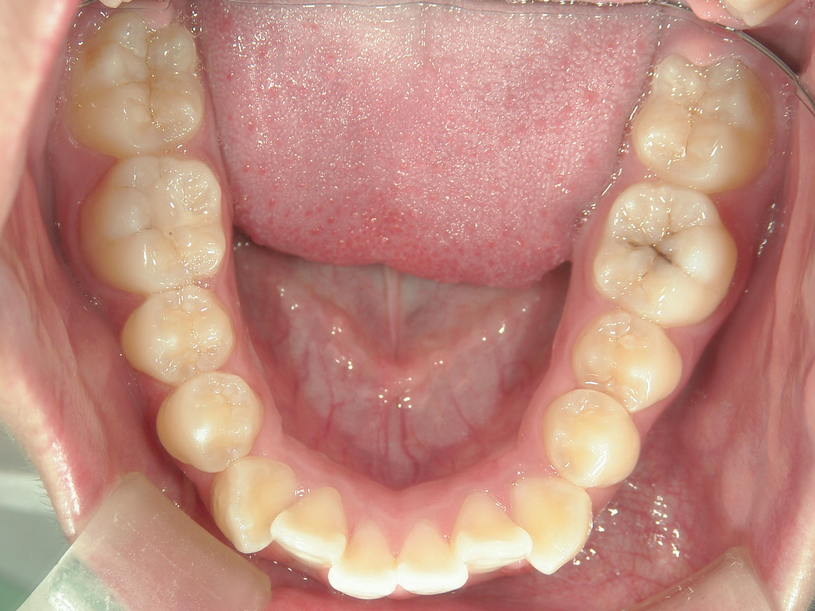 プチワイヤー矯正　症例（45）