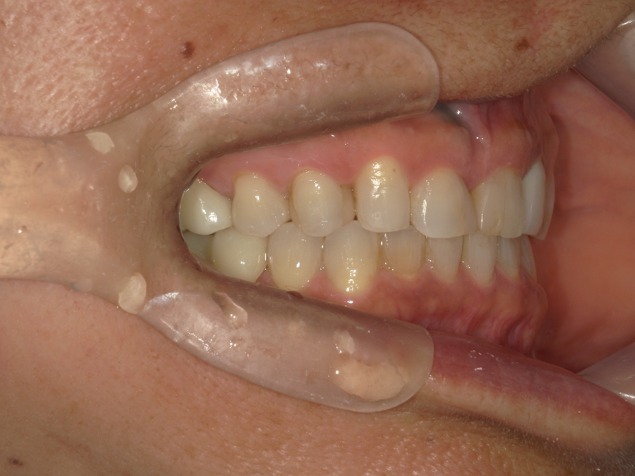 全顎ワイヤー矯正　症例（60）