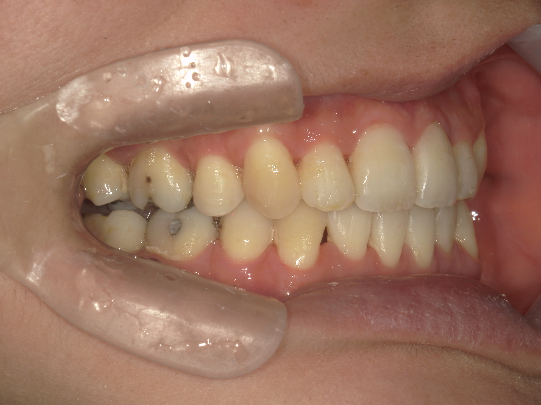 全顎ワイヤー矯正　症例（62）