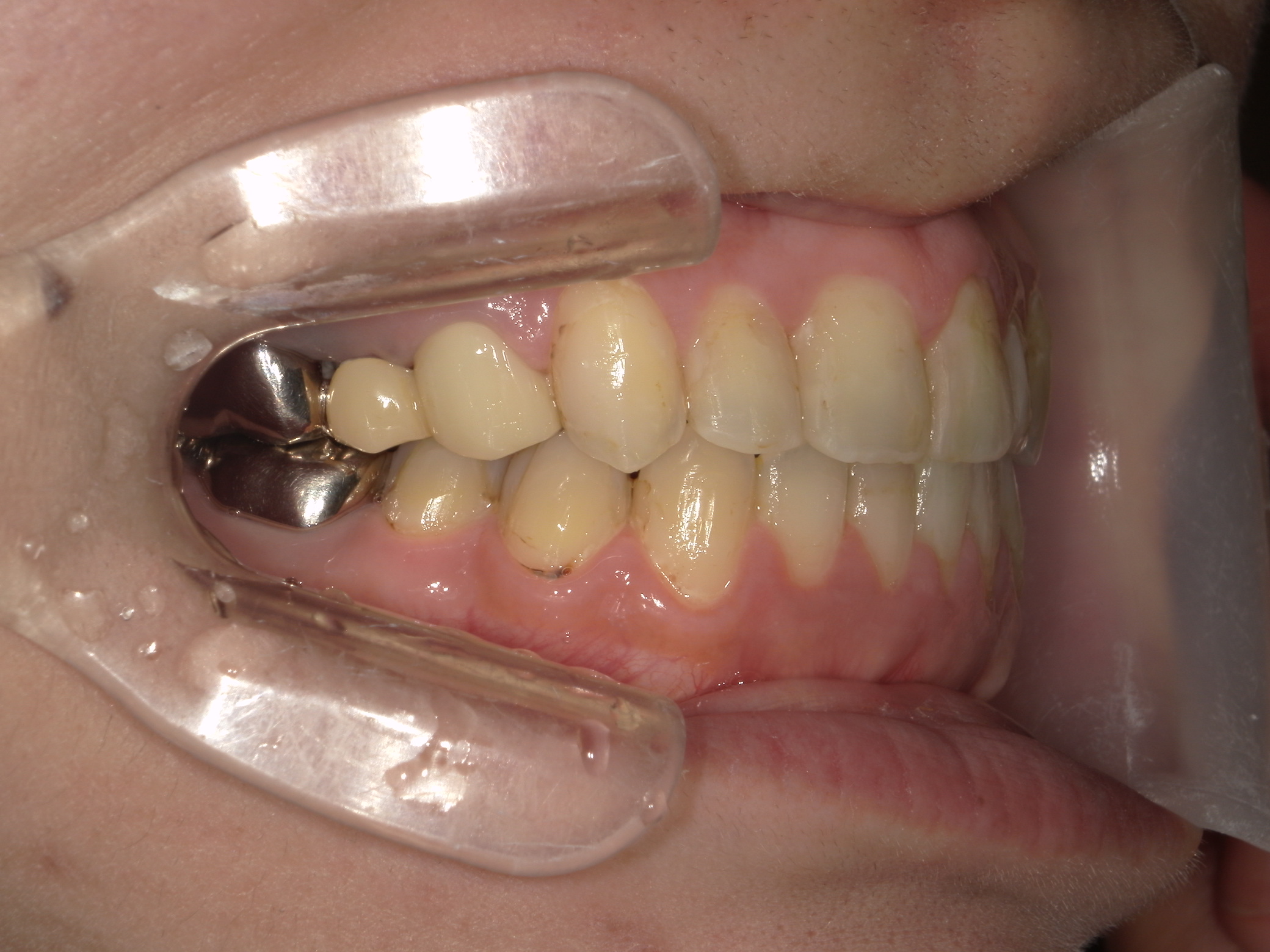 プチワイヤー矯正　症例（43）