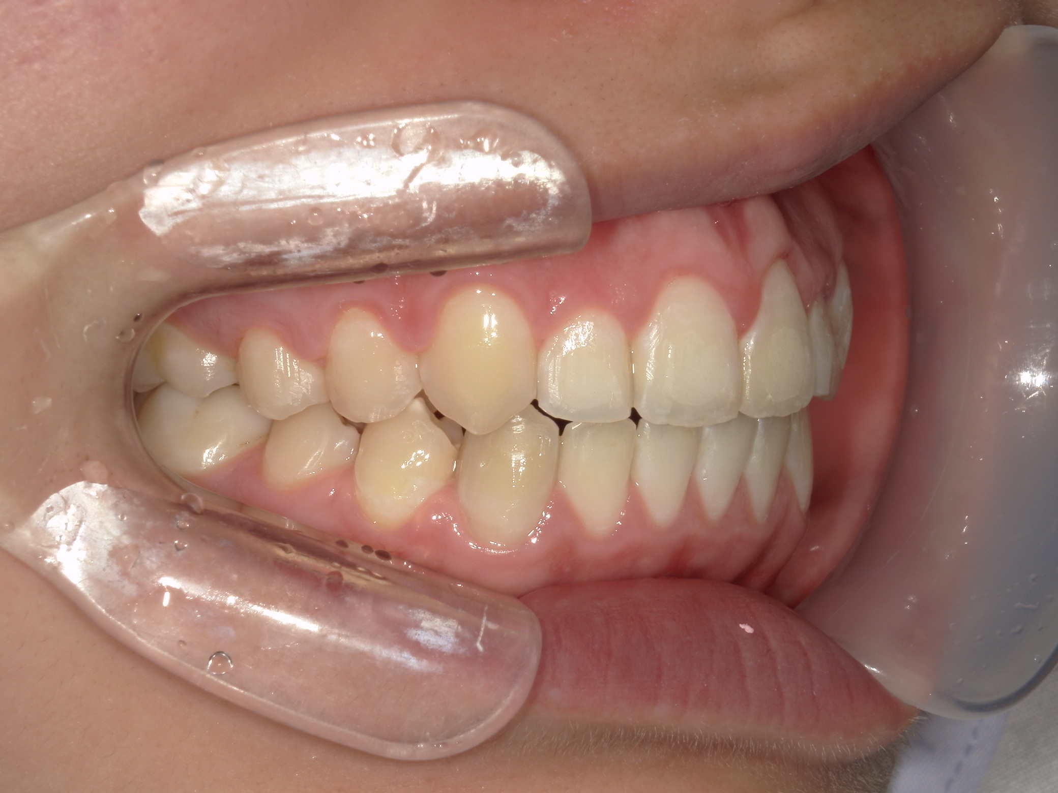 プチワイヤー矯正　症例（45）