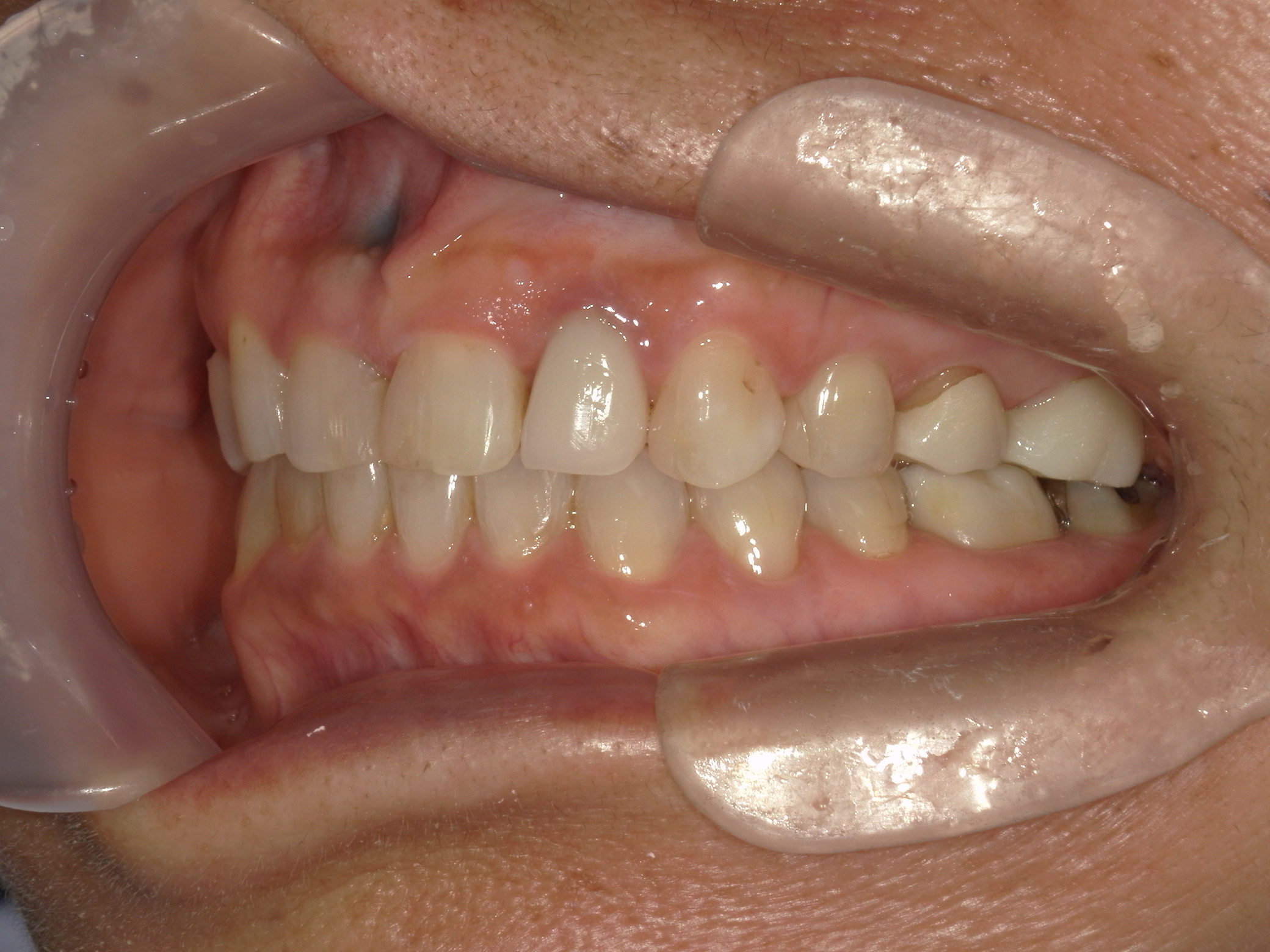 全顎ワイヤー矯正　症例（60）