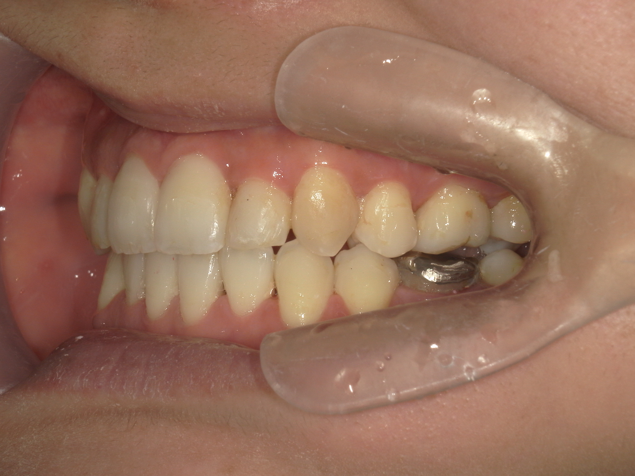 全顎ワイヤー矯正　症例（62）