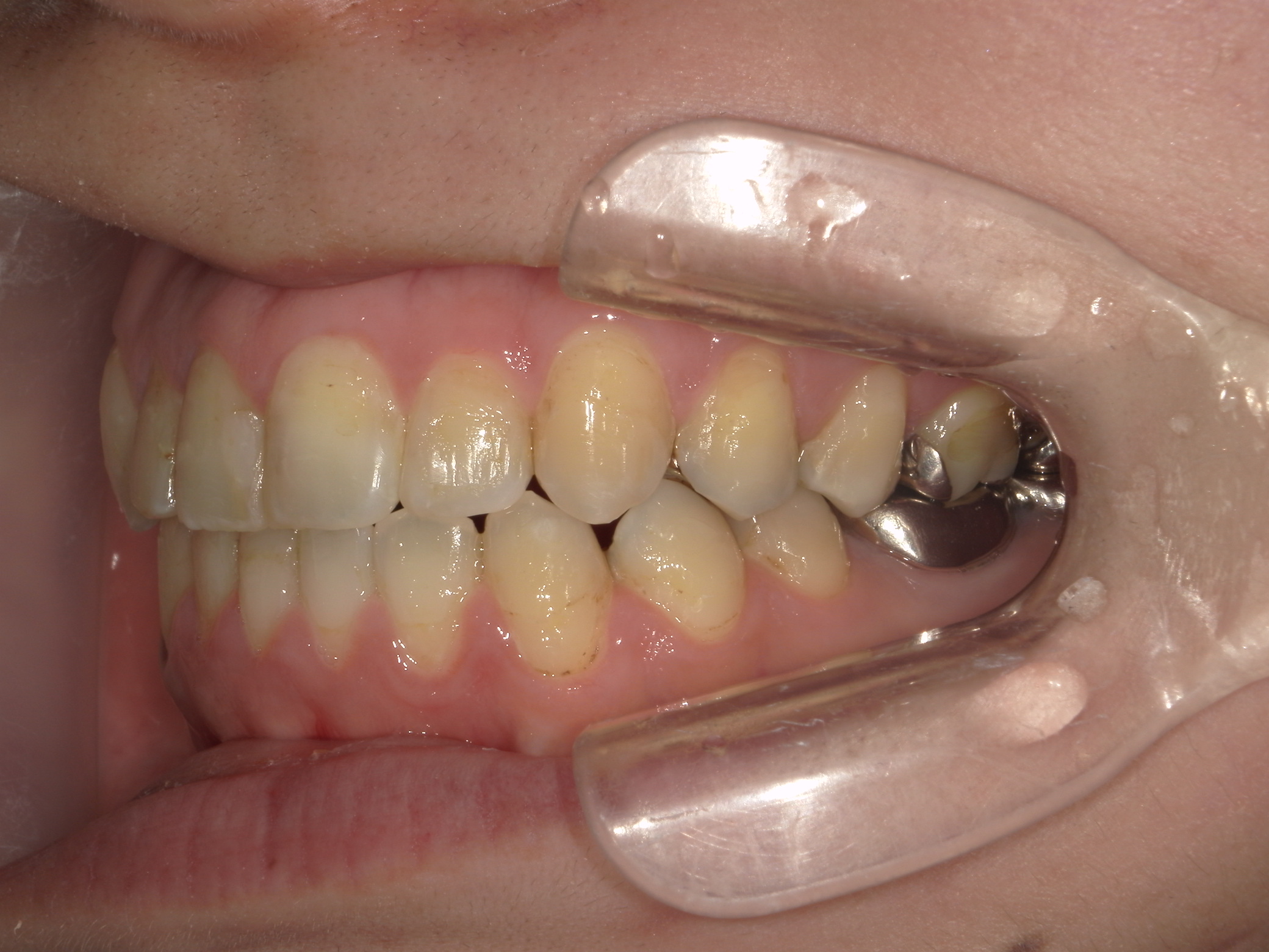 プチワイヤー矯正　症例（43）