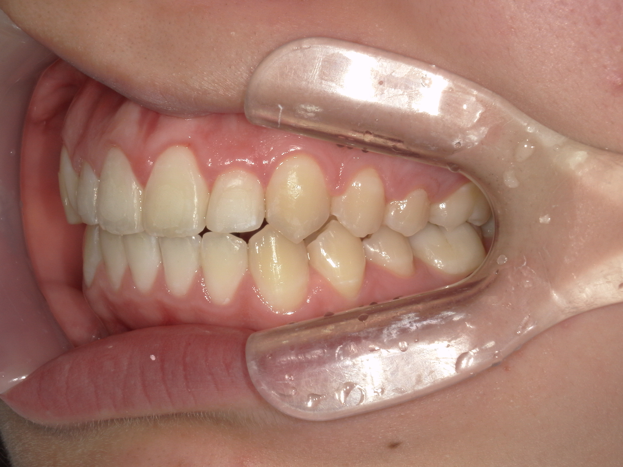 プチワイヤー矯正　症例（45）