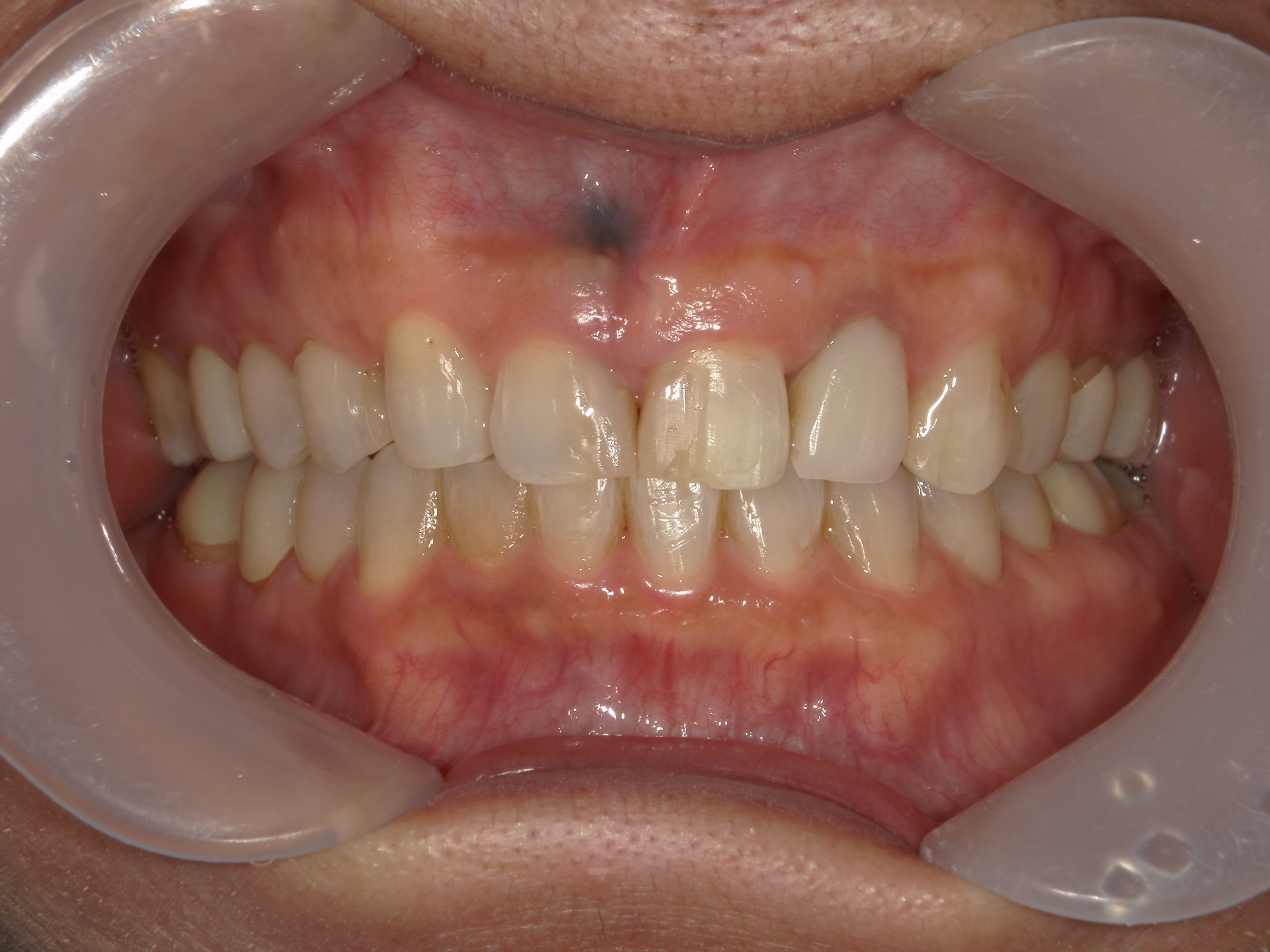 全顎ワイヤー矯正　症例（60）