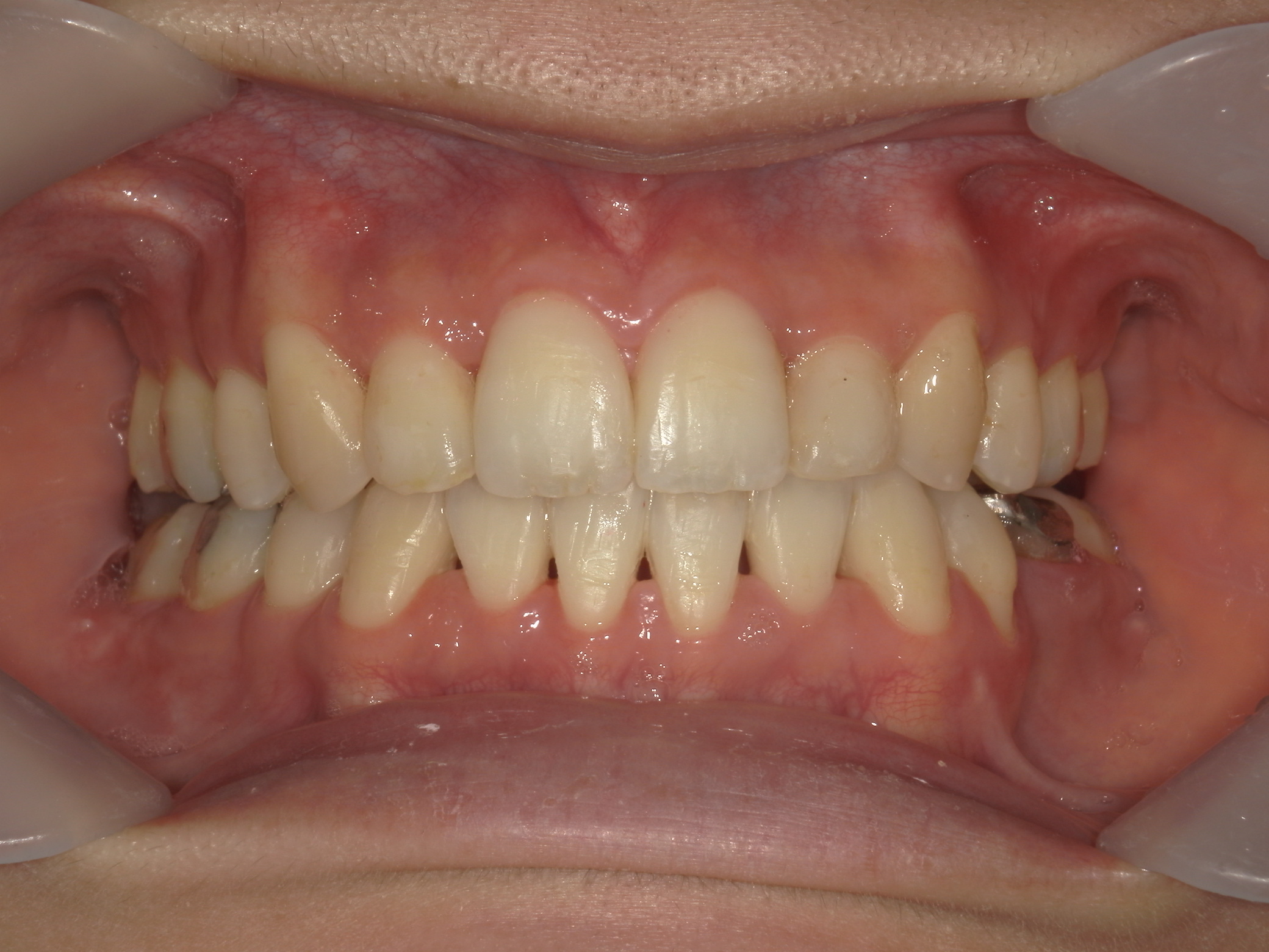 全顎ワイヤー矯正　症例（62）