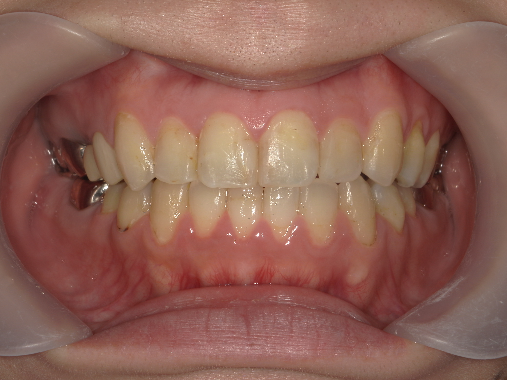 プチワイヤー矯正　症例（43）