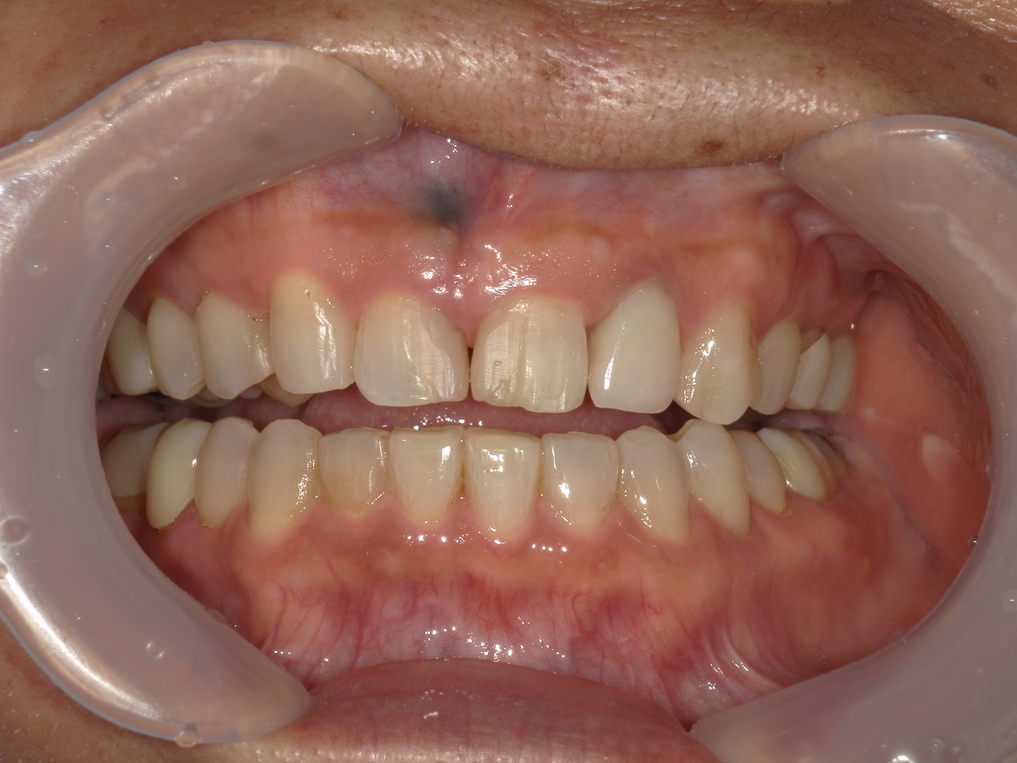 全顎ワイヤー矯正　症例（60）
