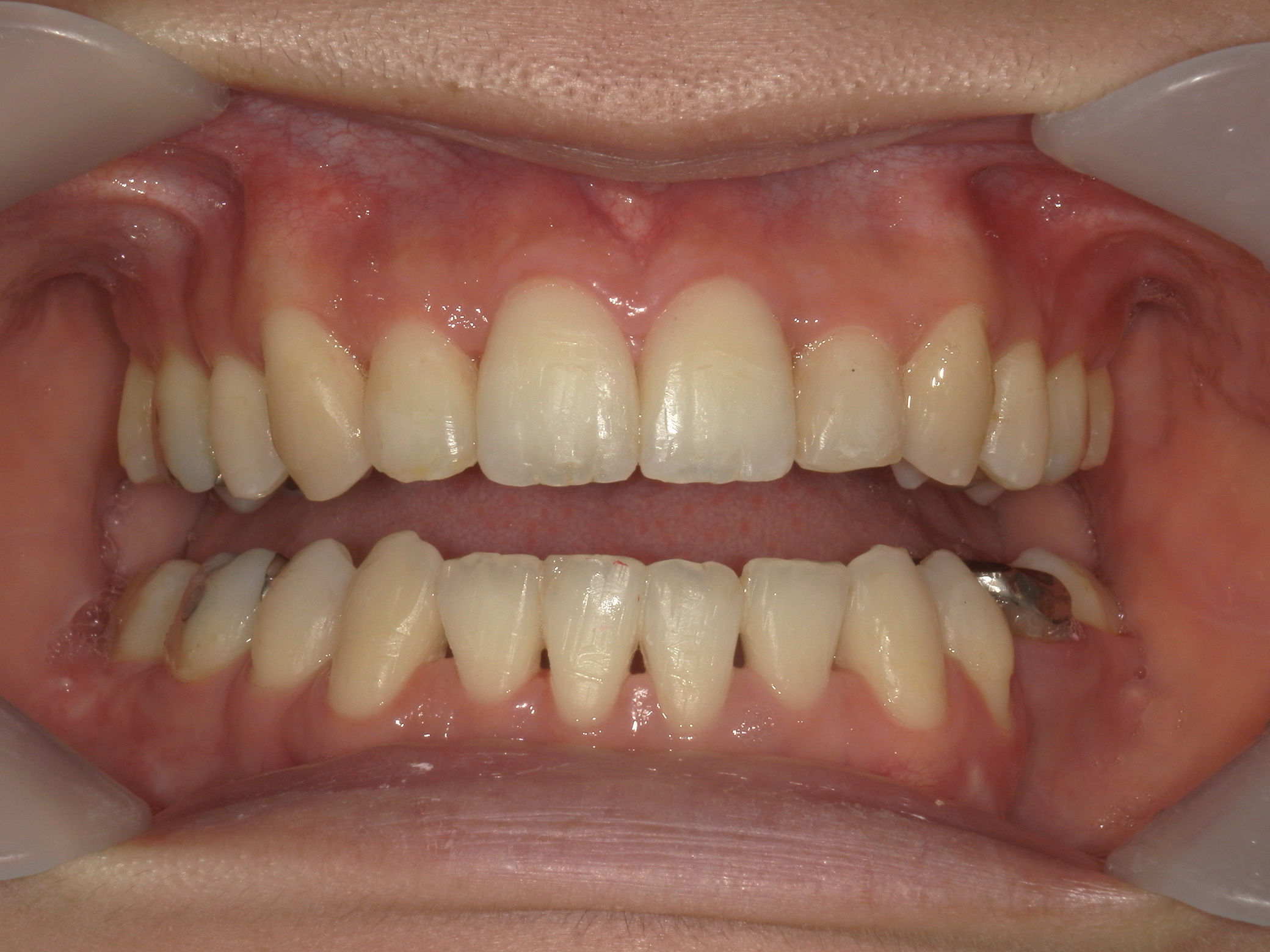 全顎ワイヤー矯正　症例（62）