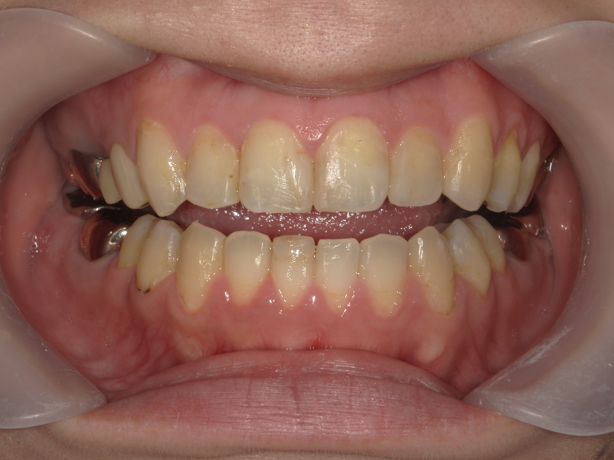 プチワイヤー矯正　症例（43）