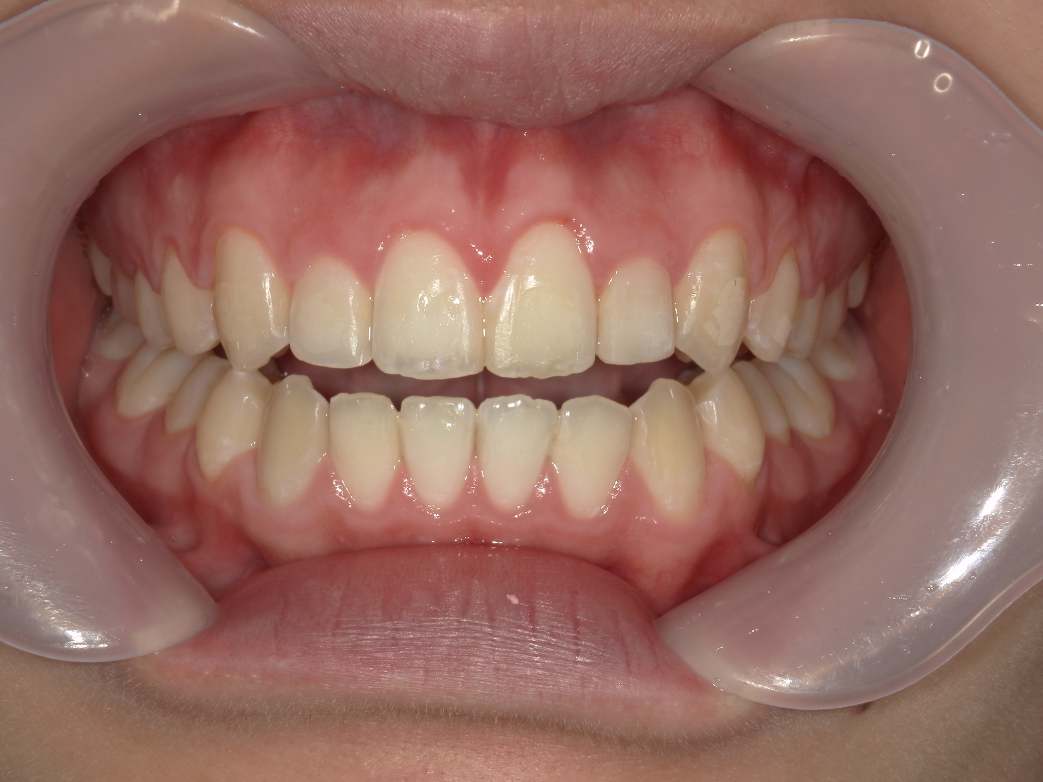 プチワイヤー矯正　症例（45）