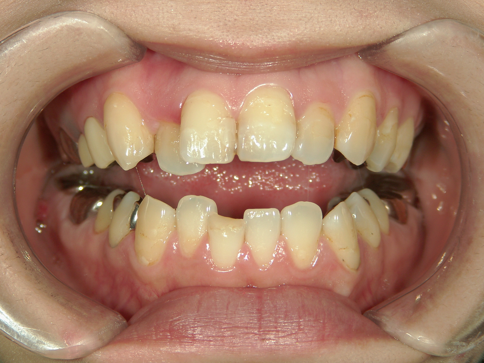 プチワイヤー矯正　症例（43）