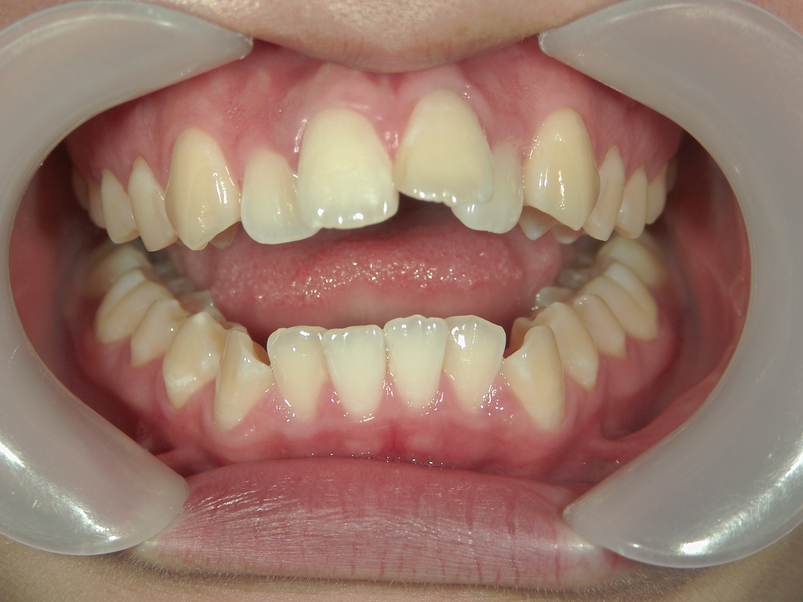 プチワイヤー矯正　症例（45）