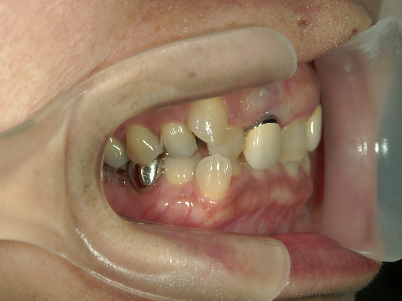 全顎ワイヤー矯正　症例（60）