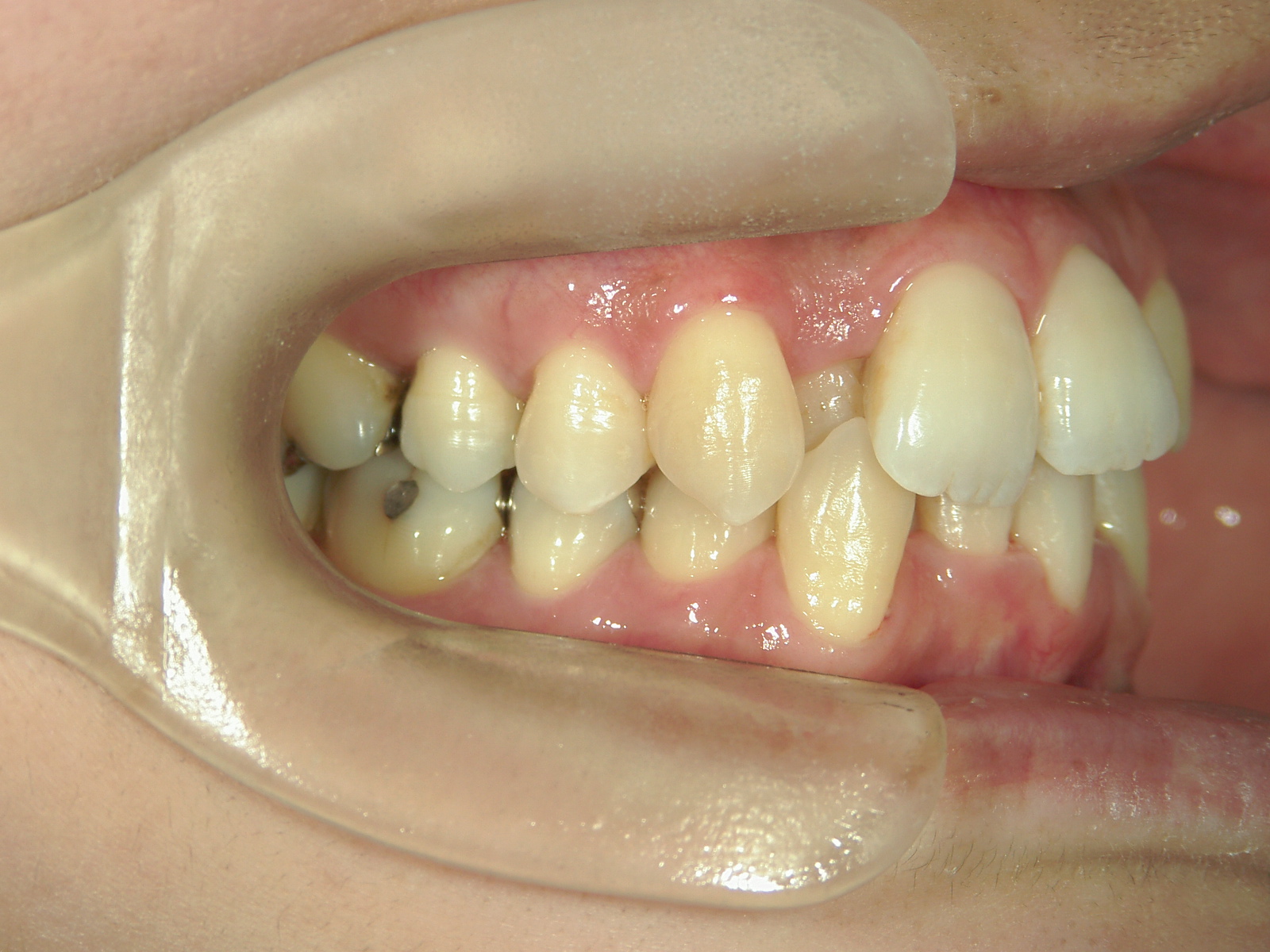 全顎ワイヤー矯正　症例（62）