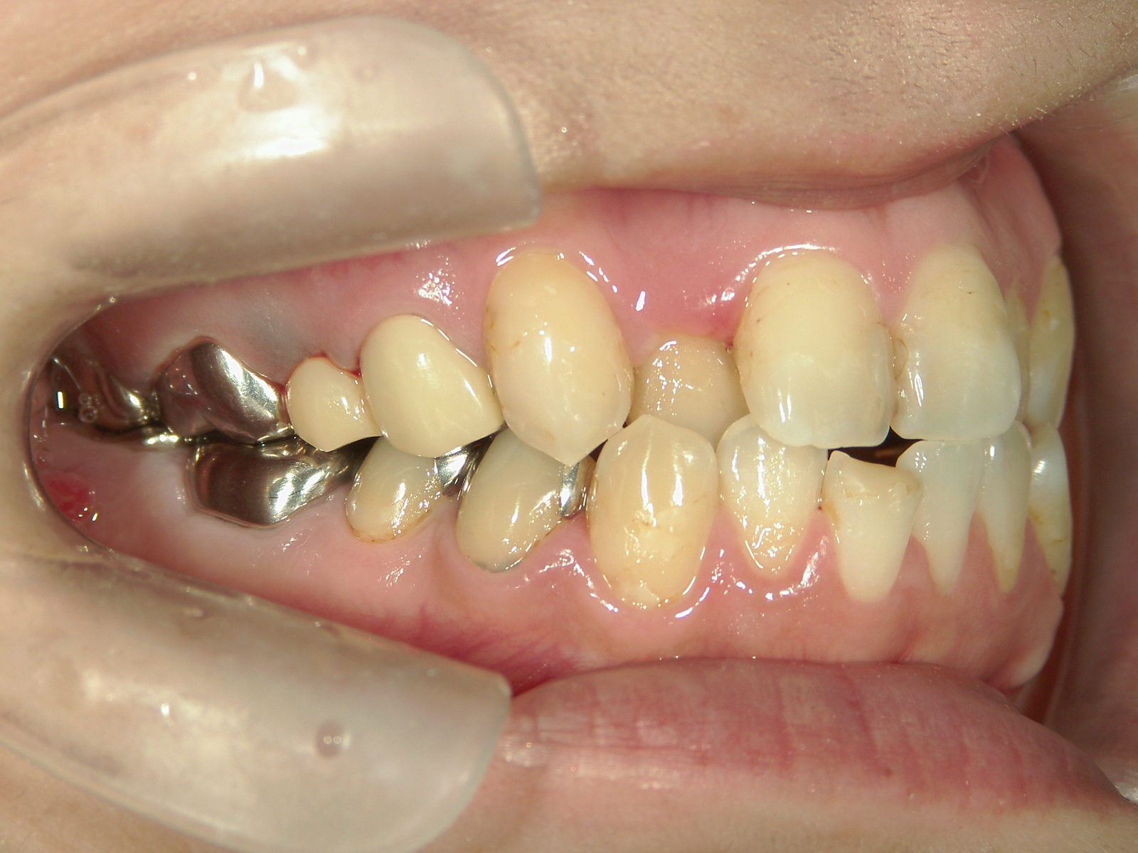 プチワイヤー矯正　症例（43）