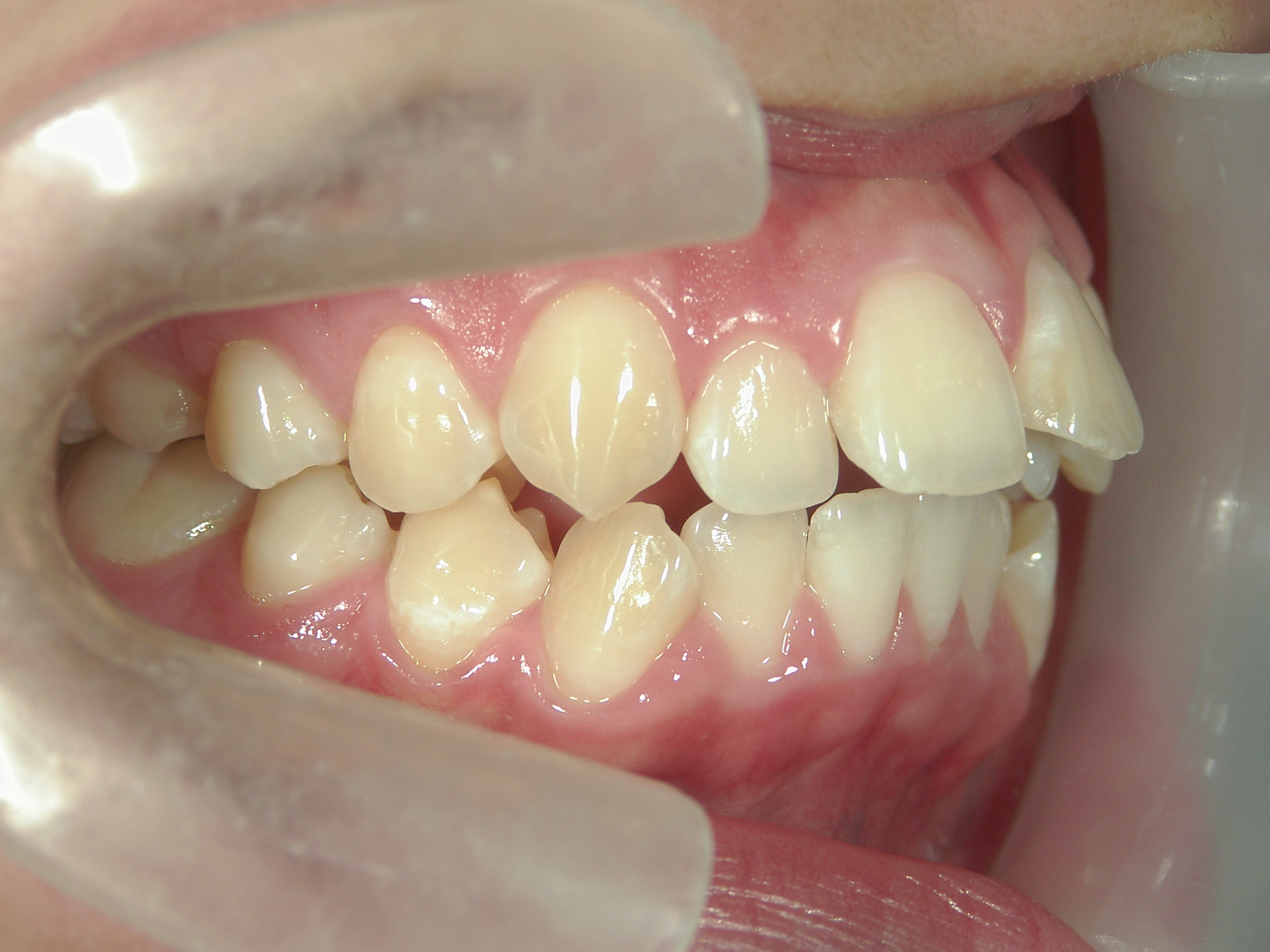 プチワイヤー矯正　症例（45）