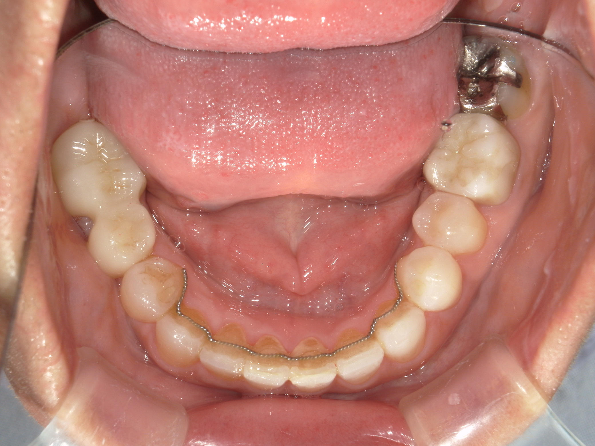 全顎ワイヤー矯正　症例（60）
