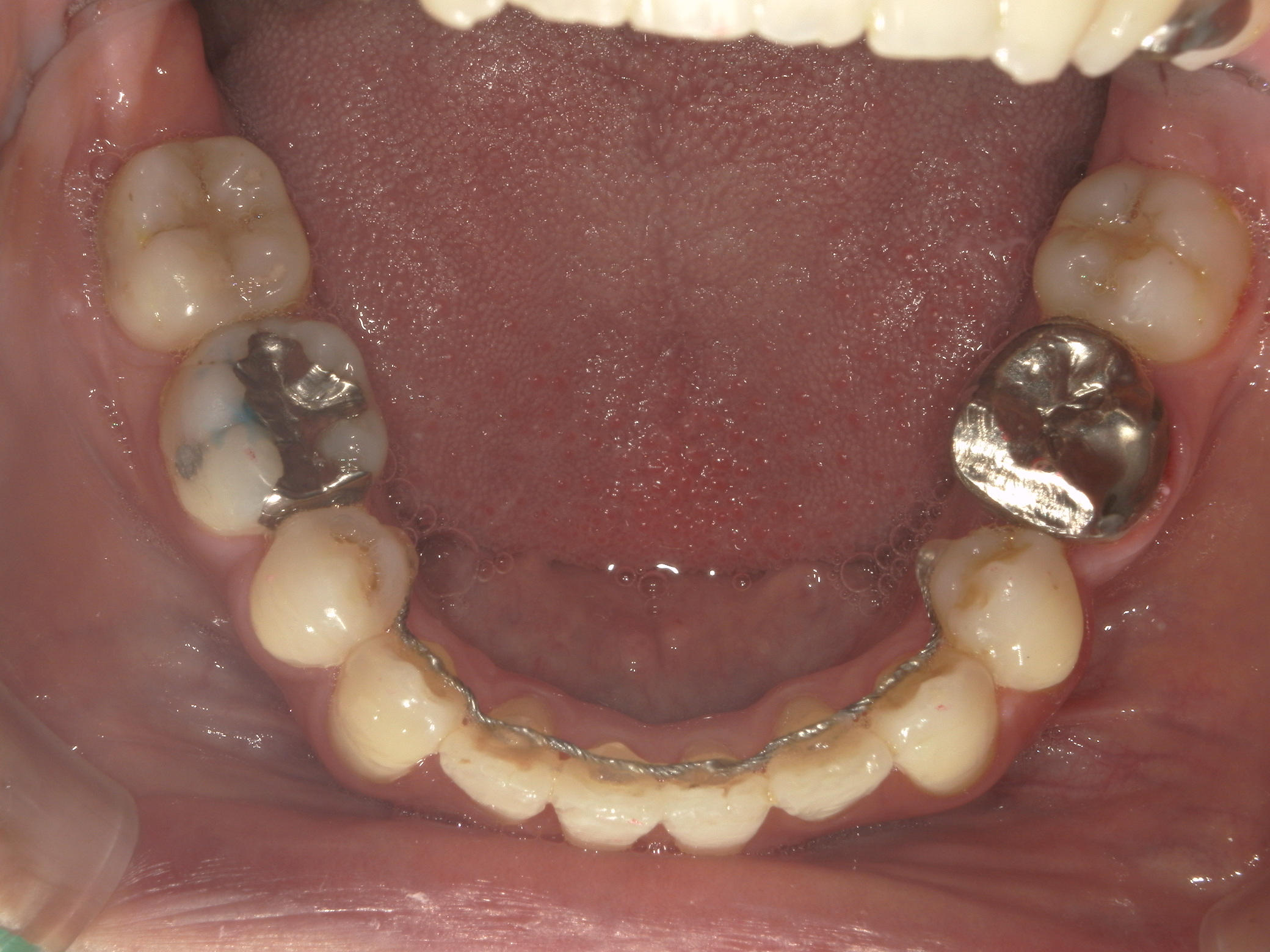 全顎ワイヤー矯正　症例（62）