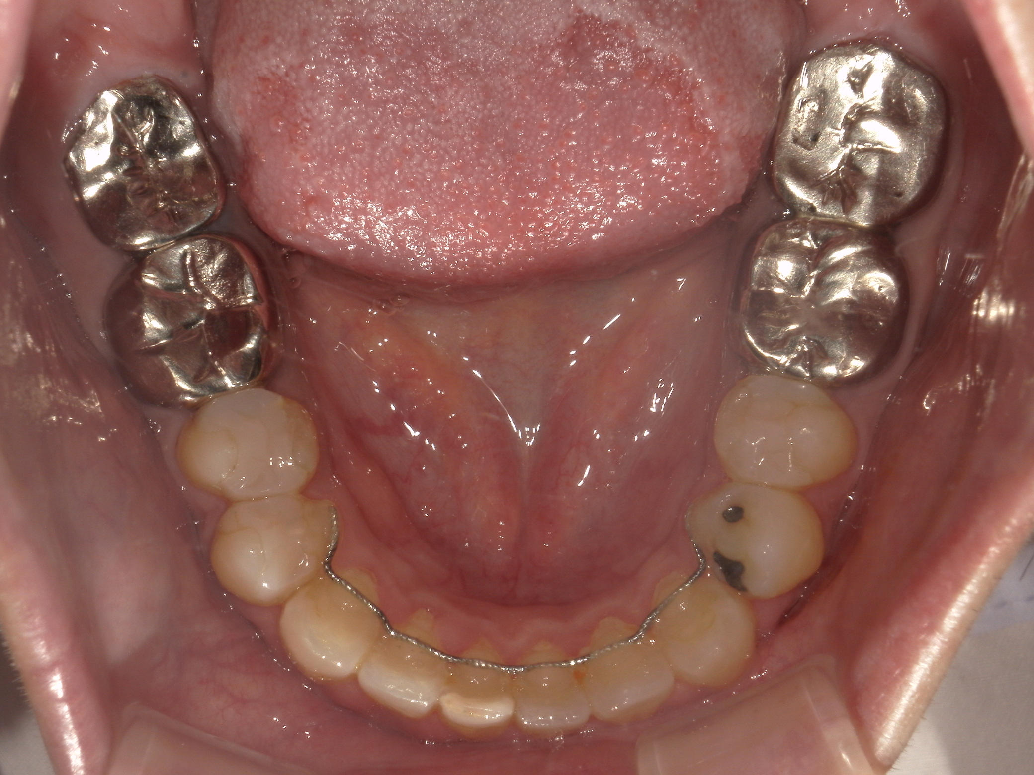 プチワイヤー矯正　症例（43）