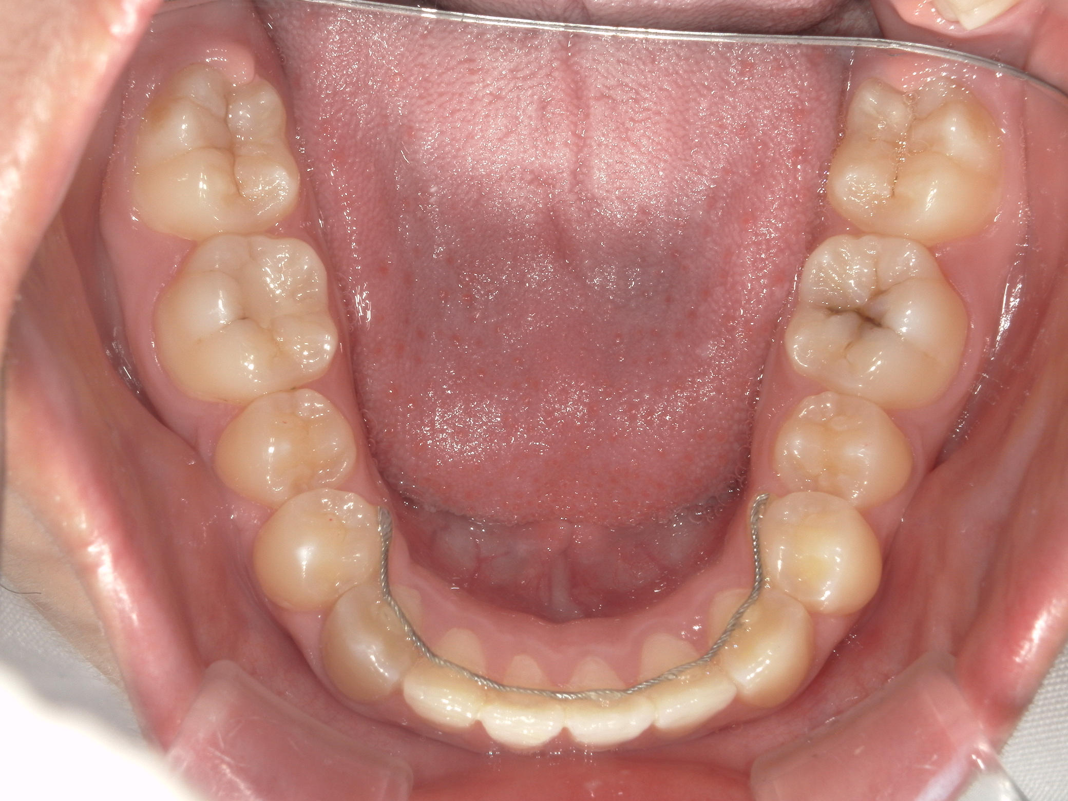 プチワイヤー矯正　症例（45）