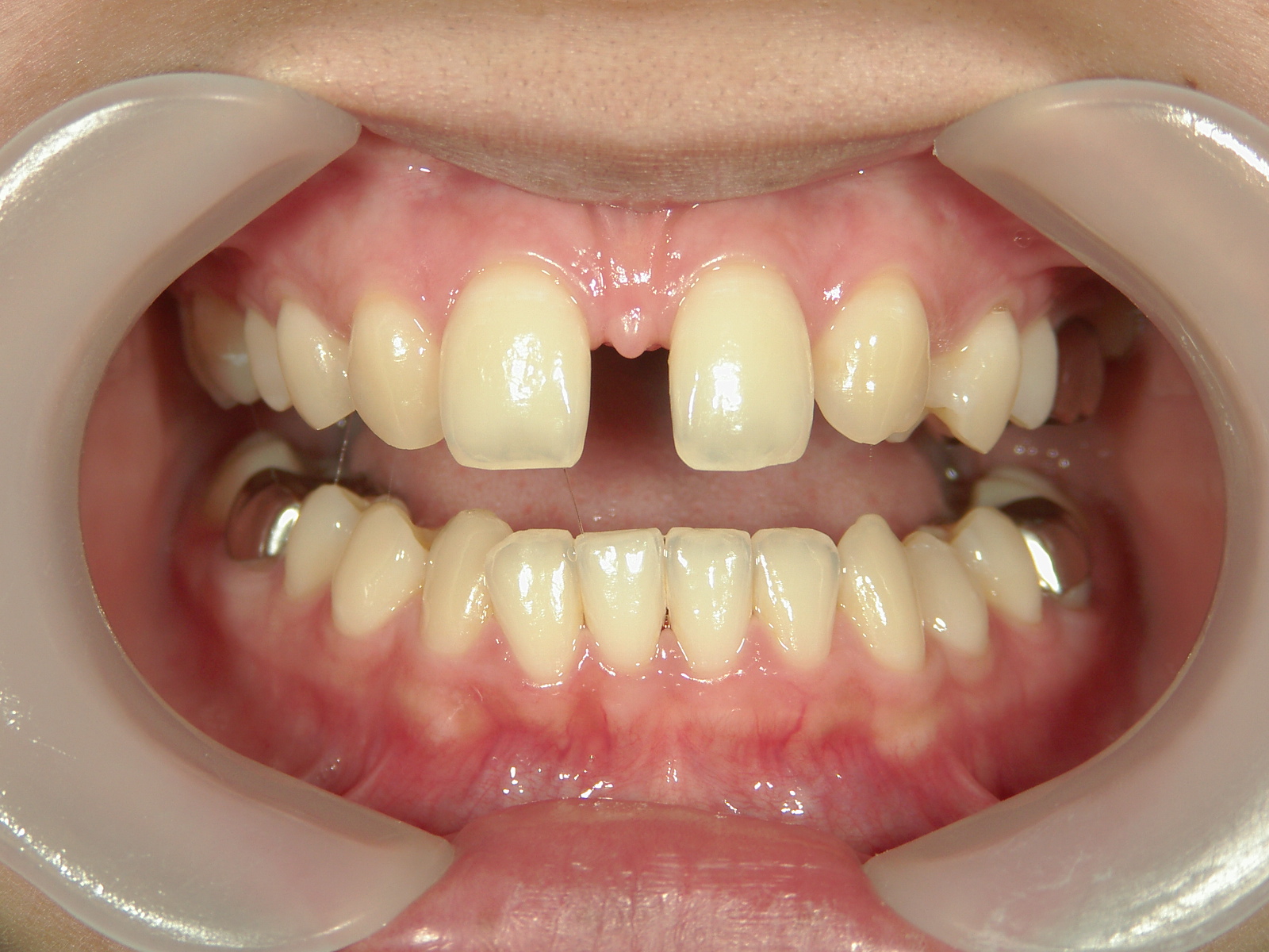 抜歯欠損症例（8）㊤前歯部2本 先欠 | 浜松市で矯正治療の期間のご相談ならいとう歯科矯正歯科ティースエクセレントクリニックへ