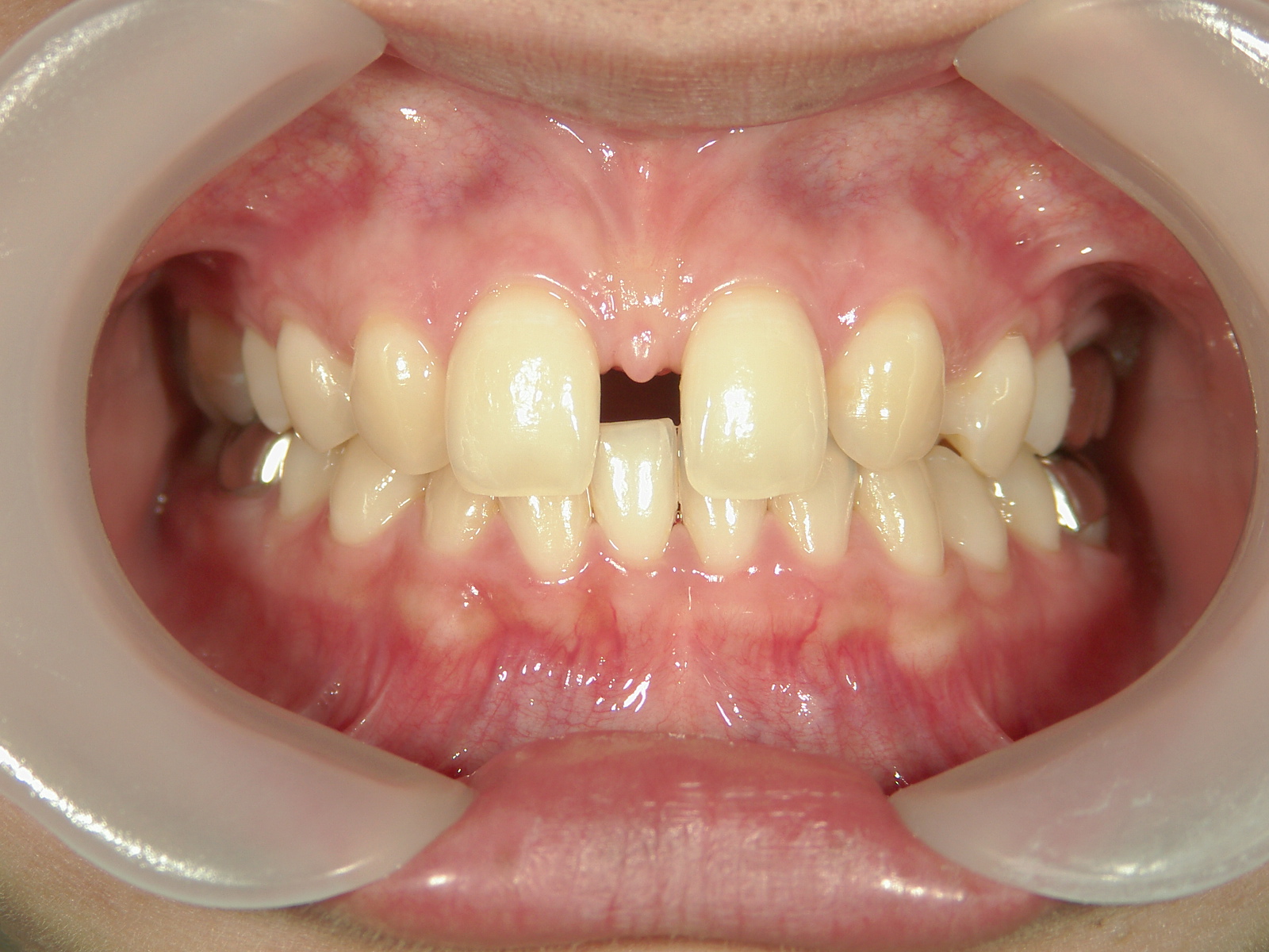 抜歯欠損症例（8）㊤前歯部2本 先欠
