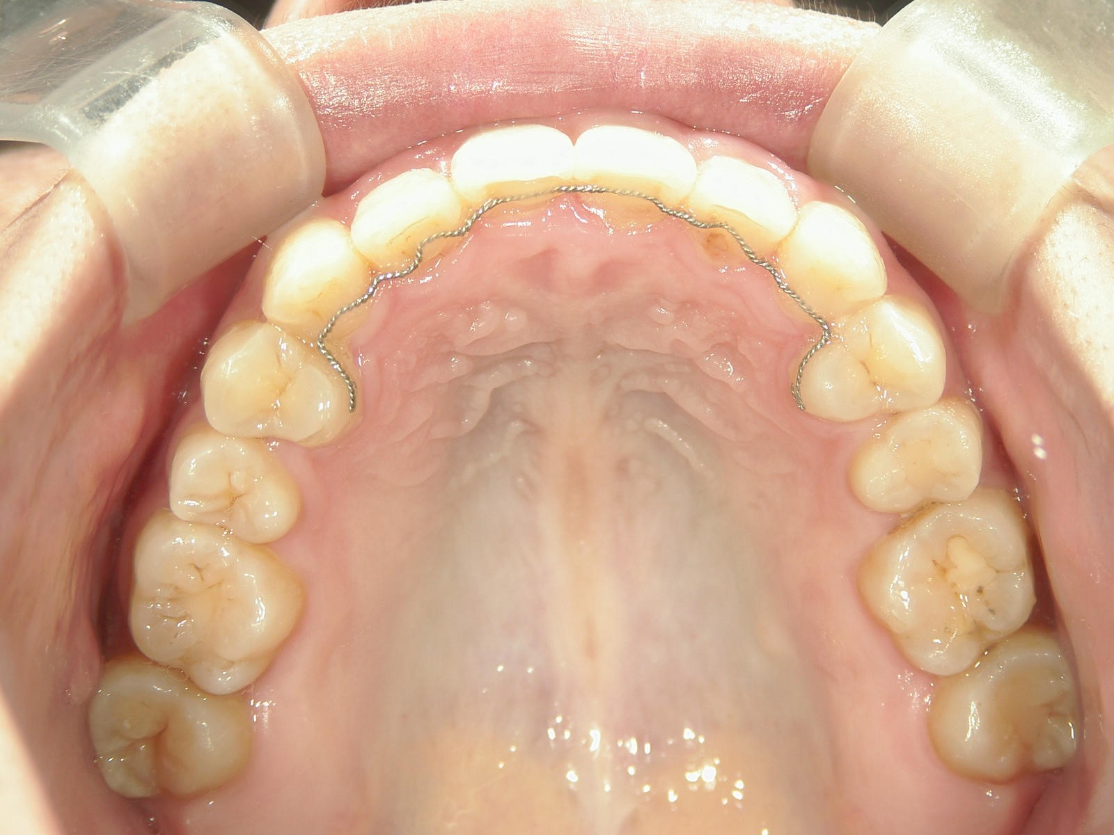 非抜歯症例（7）