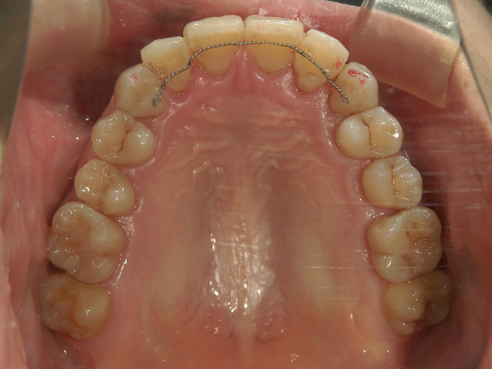 非抜歯症例（8）
