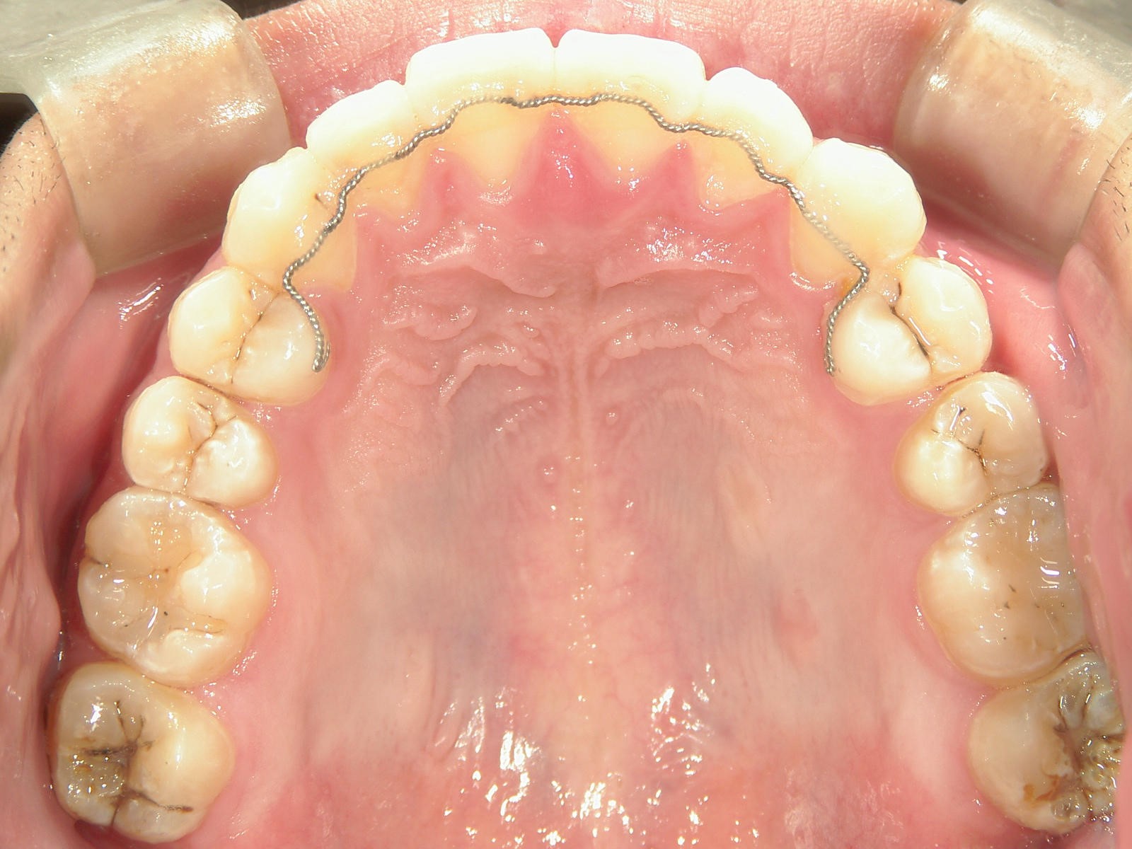 非抜歯症例（9）