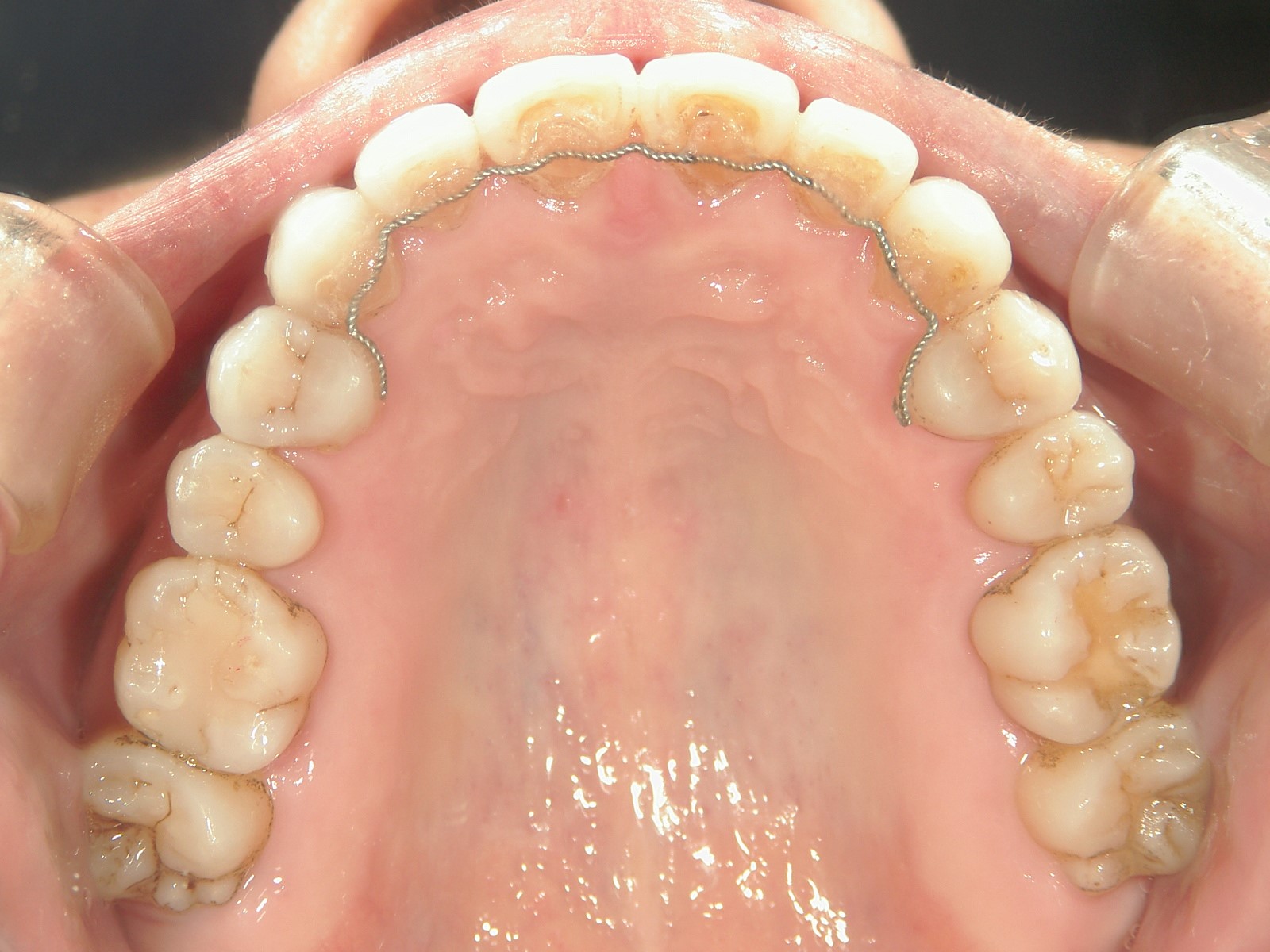 非抜歯症例（12）