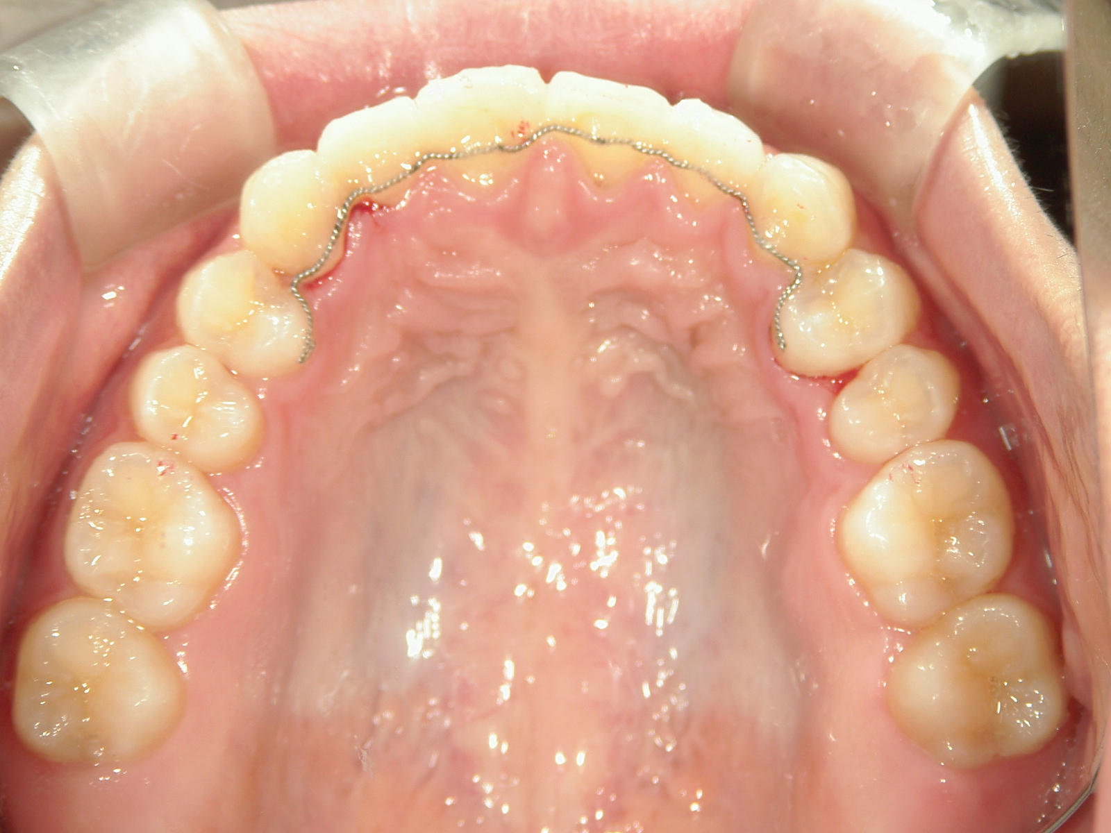 非抜歯症例（13）